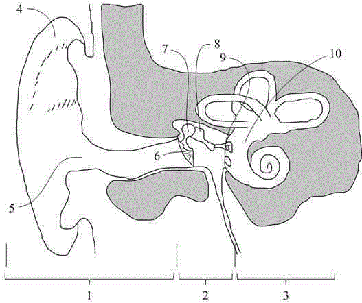 Artificial auditory ossicle for treating mixed hearing damage