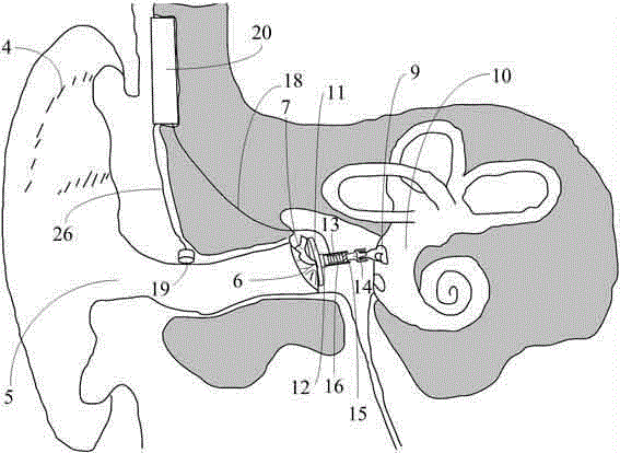 Artificial auditory ossicle for treating mixed hearing damage