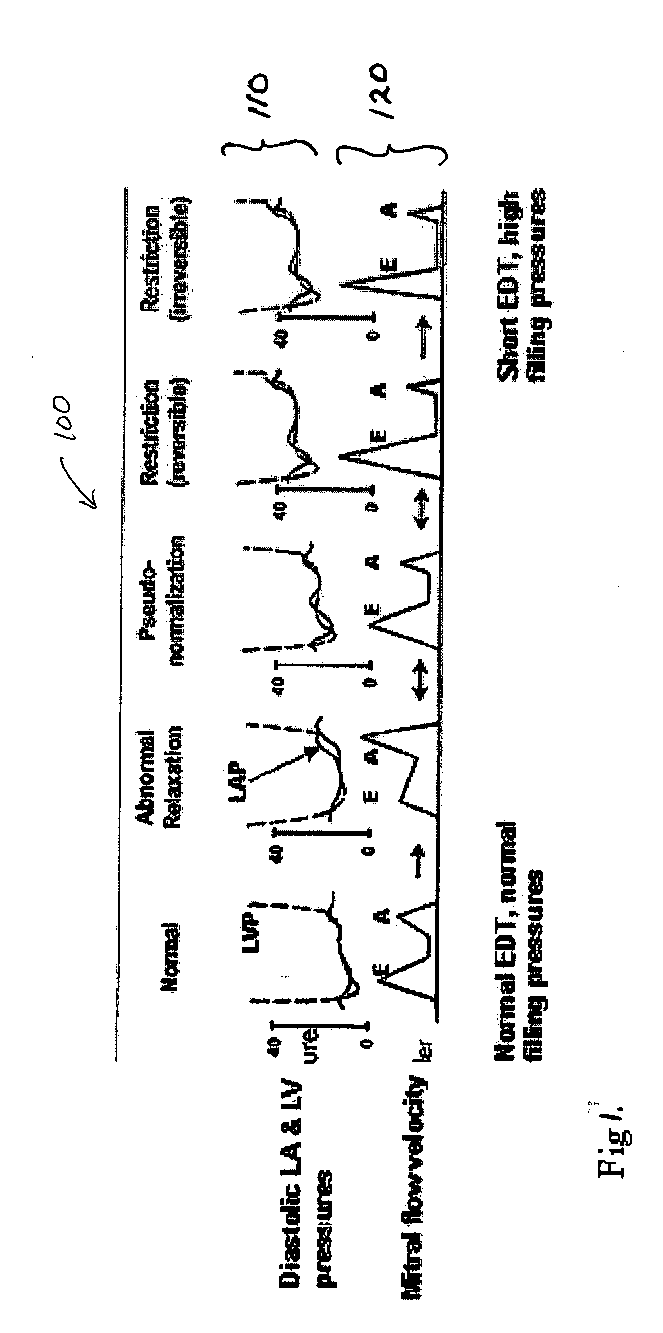 Ischemia detection using a heart sound sensor