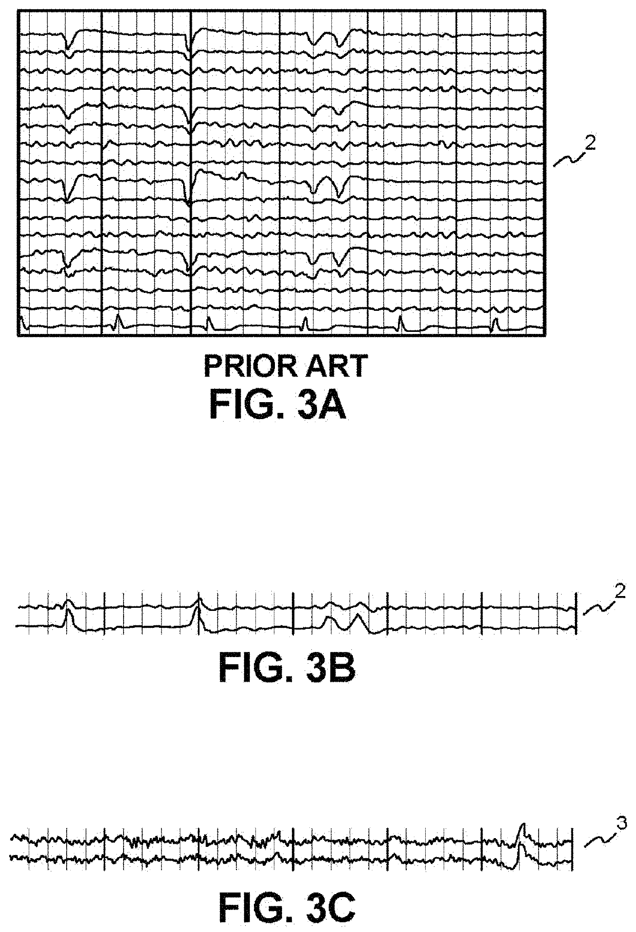 Apparatus, systems and methods for predicting, screening and monitoring of mortality and other conditions   uirf 19054