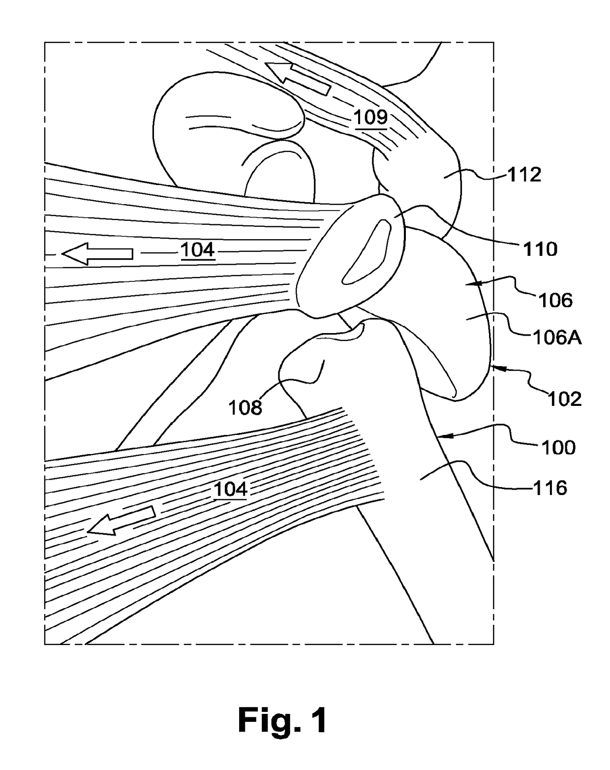 Surgical technique and apparatus for proximal humeral fracture repair