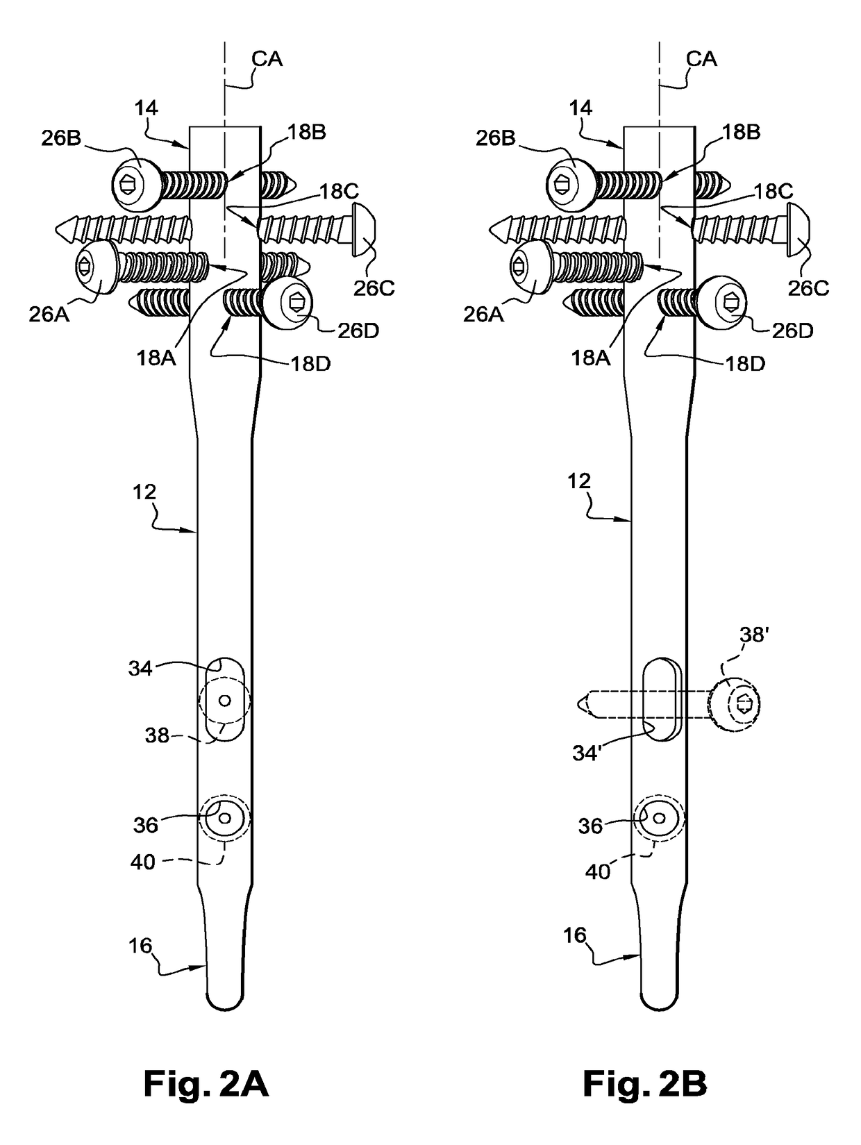 Surgical technique and apparatus for proximal humeral fracture repair