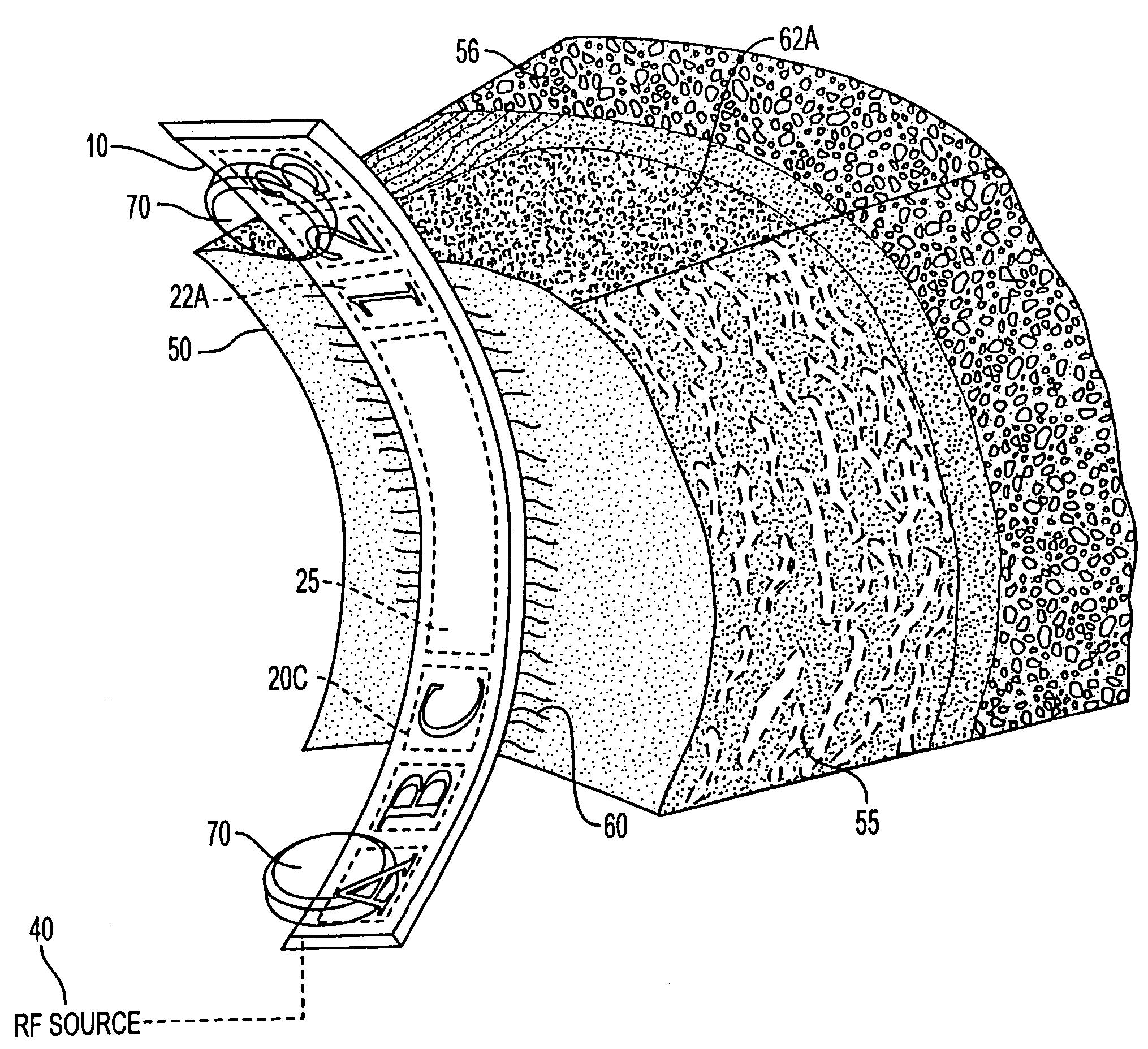 RF electrode array for low-rate collagen shrinkage in capsular shift procedures and methods of use