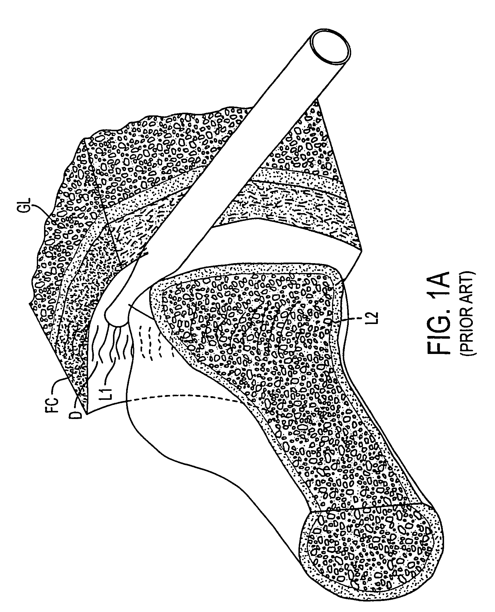 RF electrode array for low-rate collagen shrinkage in capsular shift procedures and methods of use