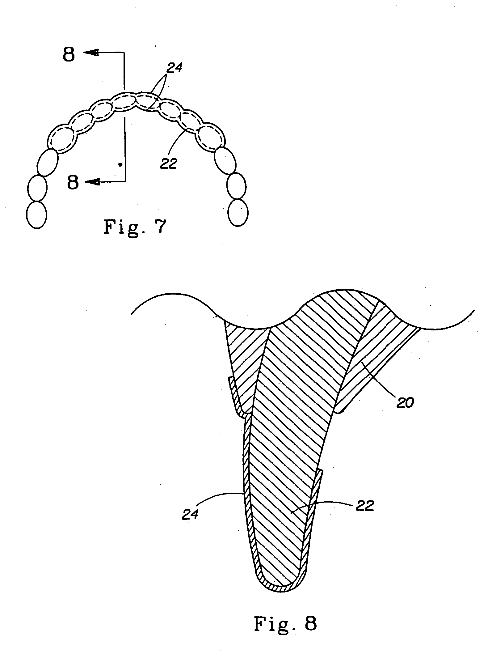 Dye composition and method for detection of demineralized lesions in teeth