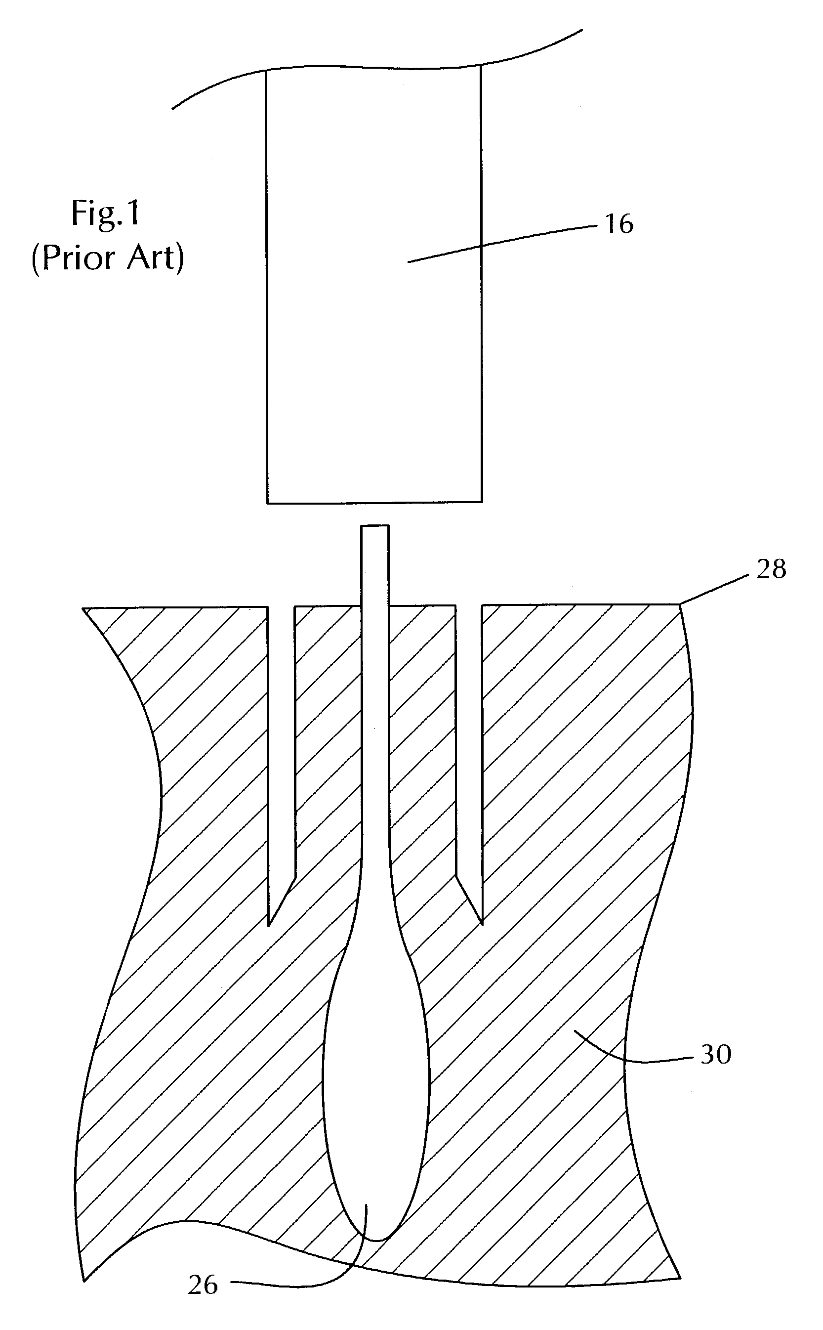 Method and apparatus for follicular extraction and transplantation