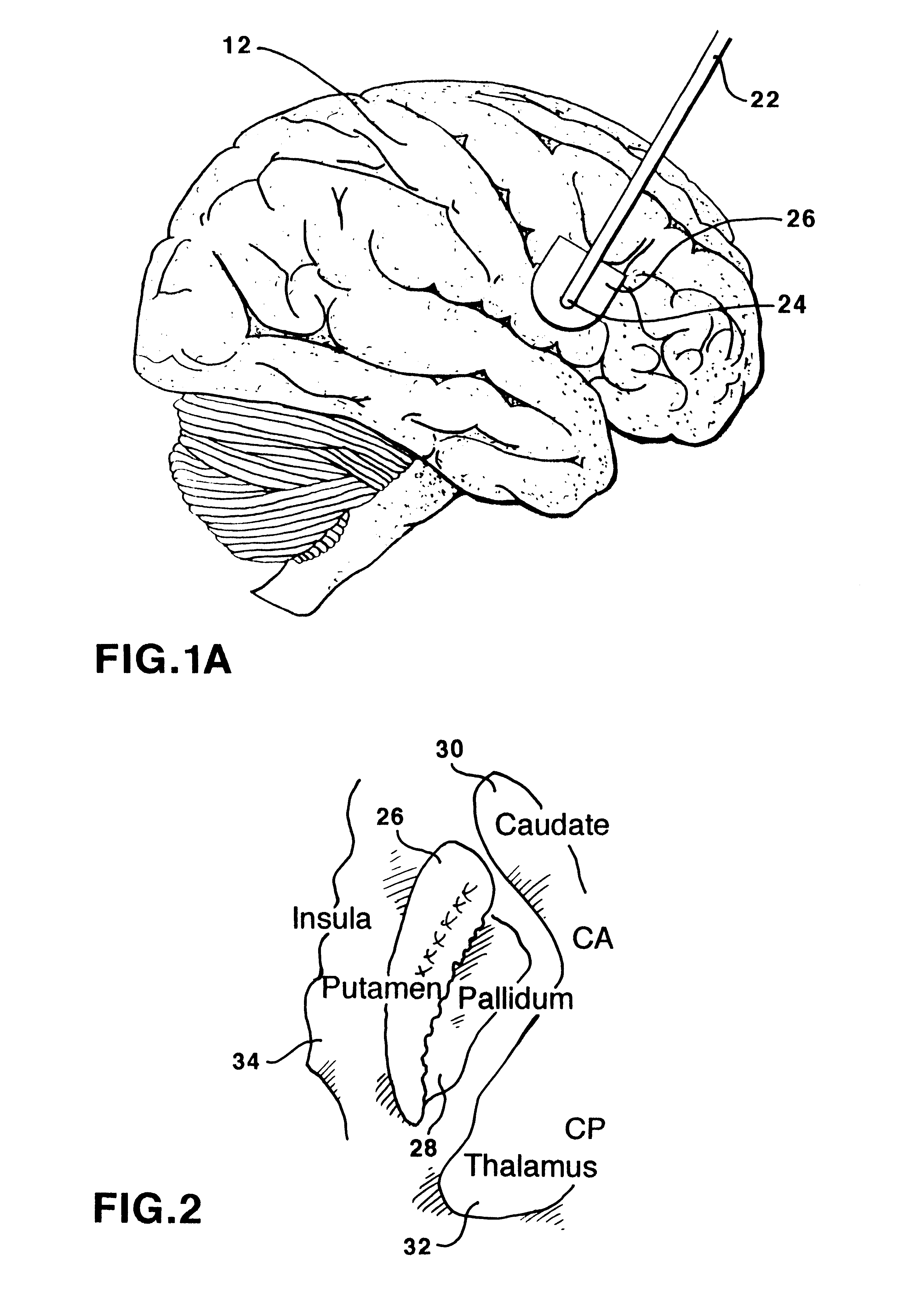 Method for manufacturing a catheter