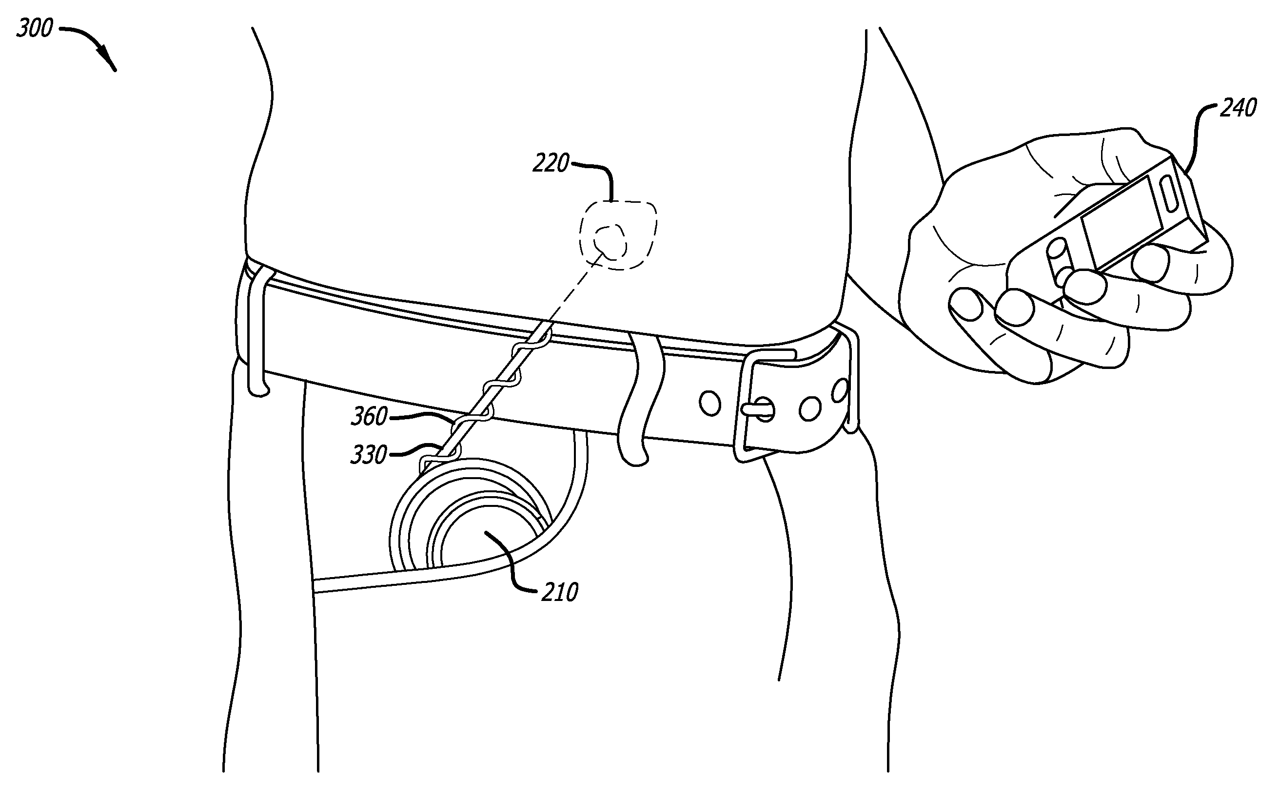 Medical device antenna systems having external antenna configurations