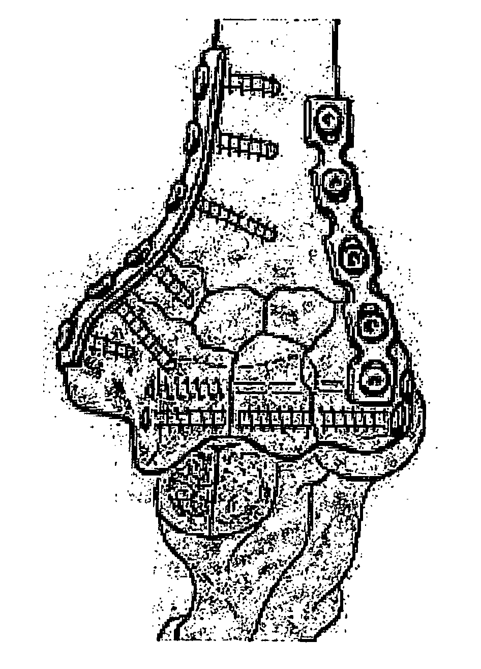 Osteosynthesis plate set