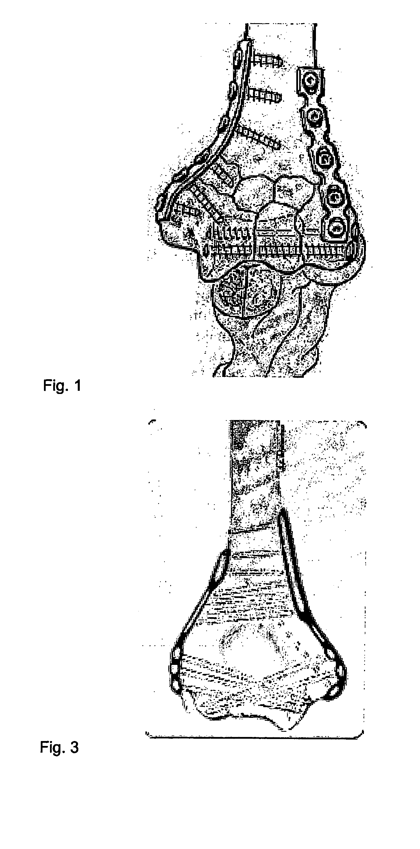 Osteosynthesis plate set