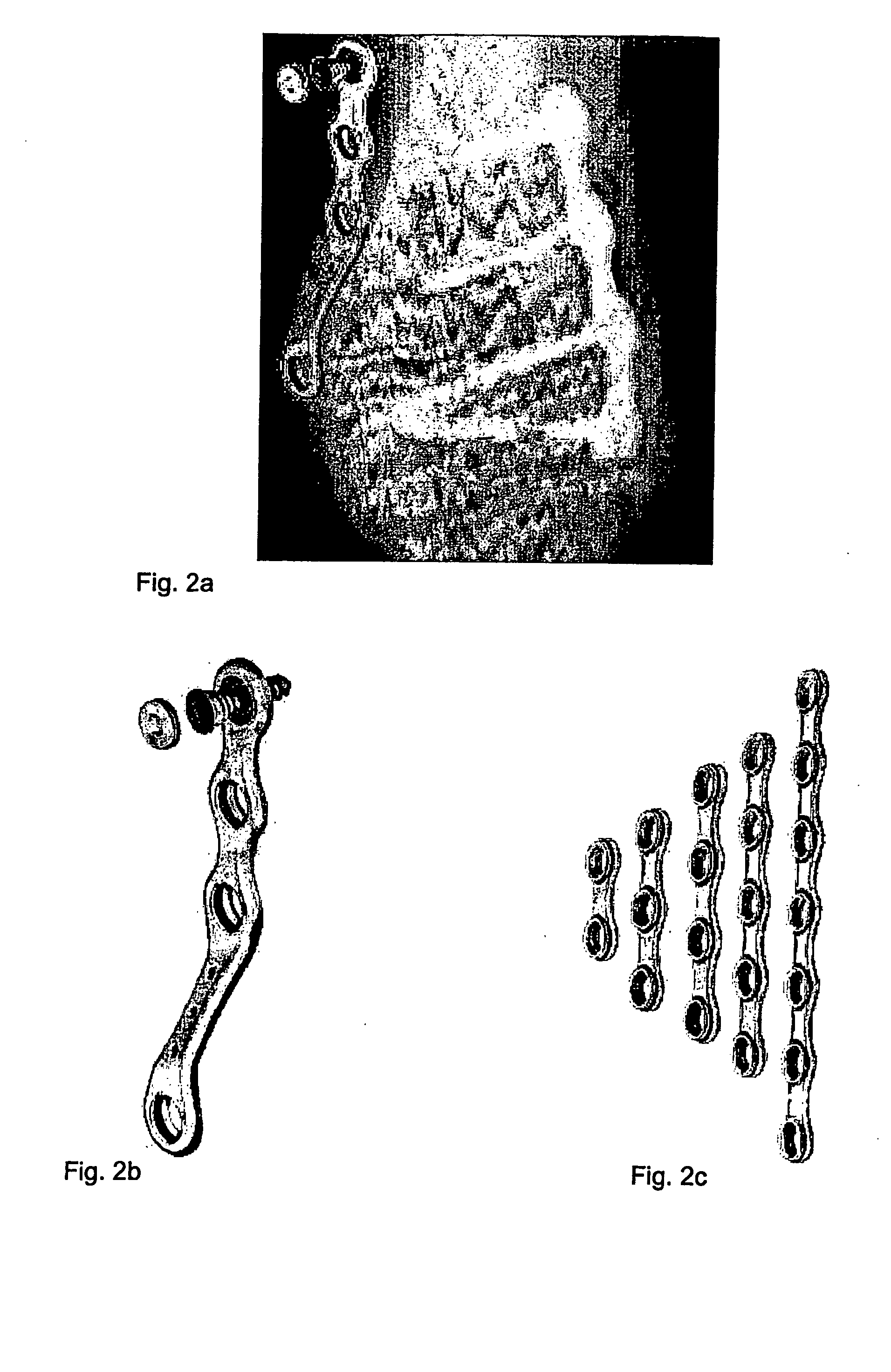 Osteosynthesis plate set