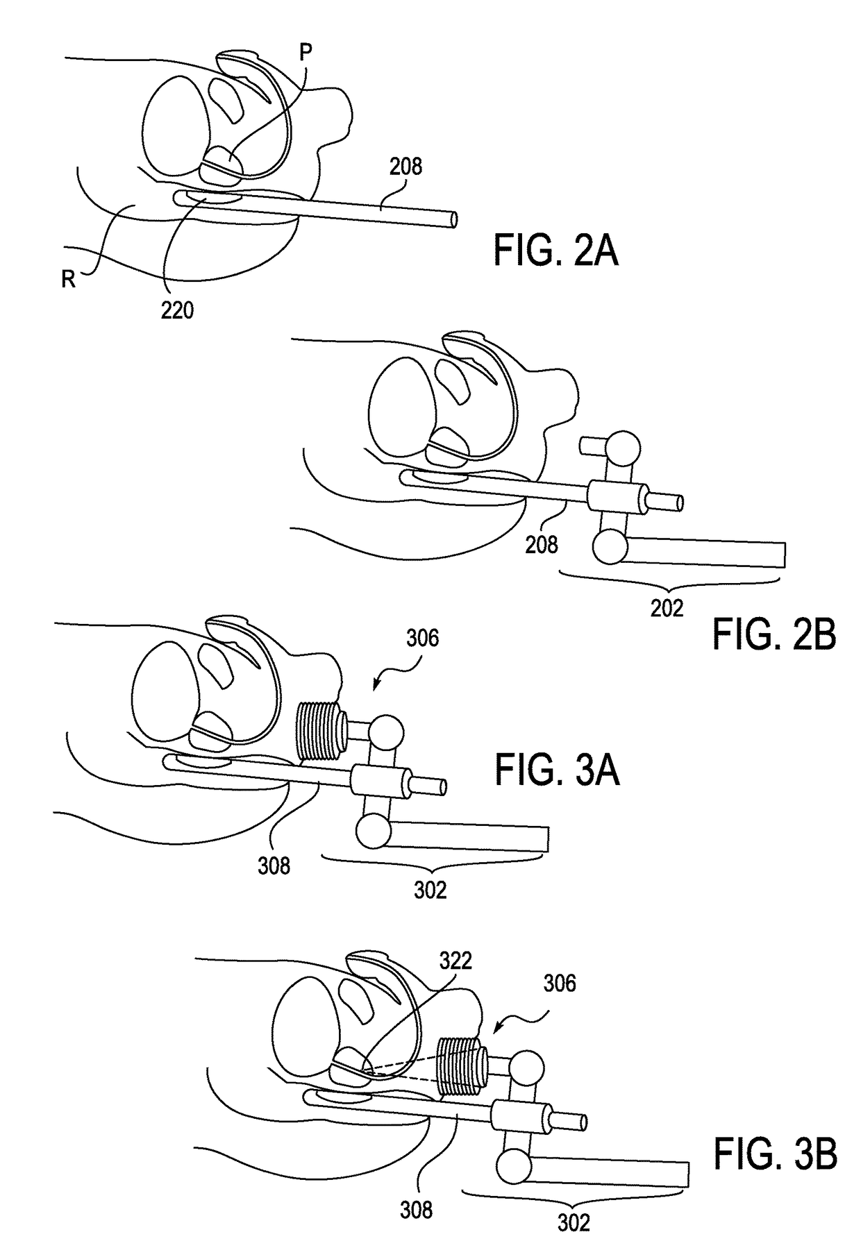 Automated control of micromanipulator arm for histotripsy prostate therapy while imaging via ultrasound transducers in real time