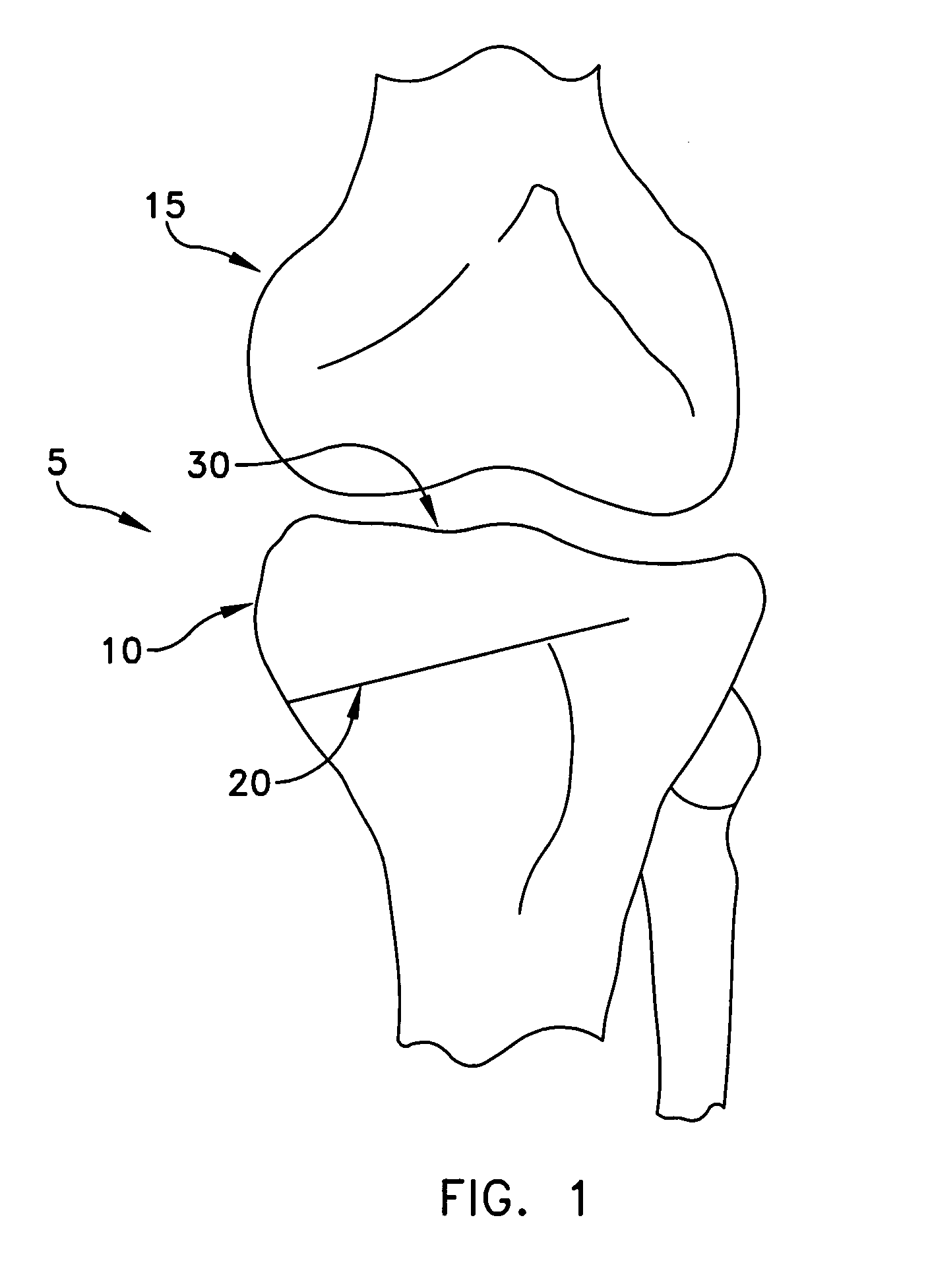 Method and apparatus for performing an open wedge, high tibial osteotomy