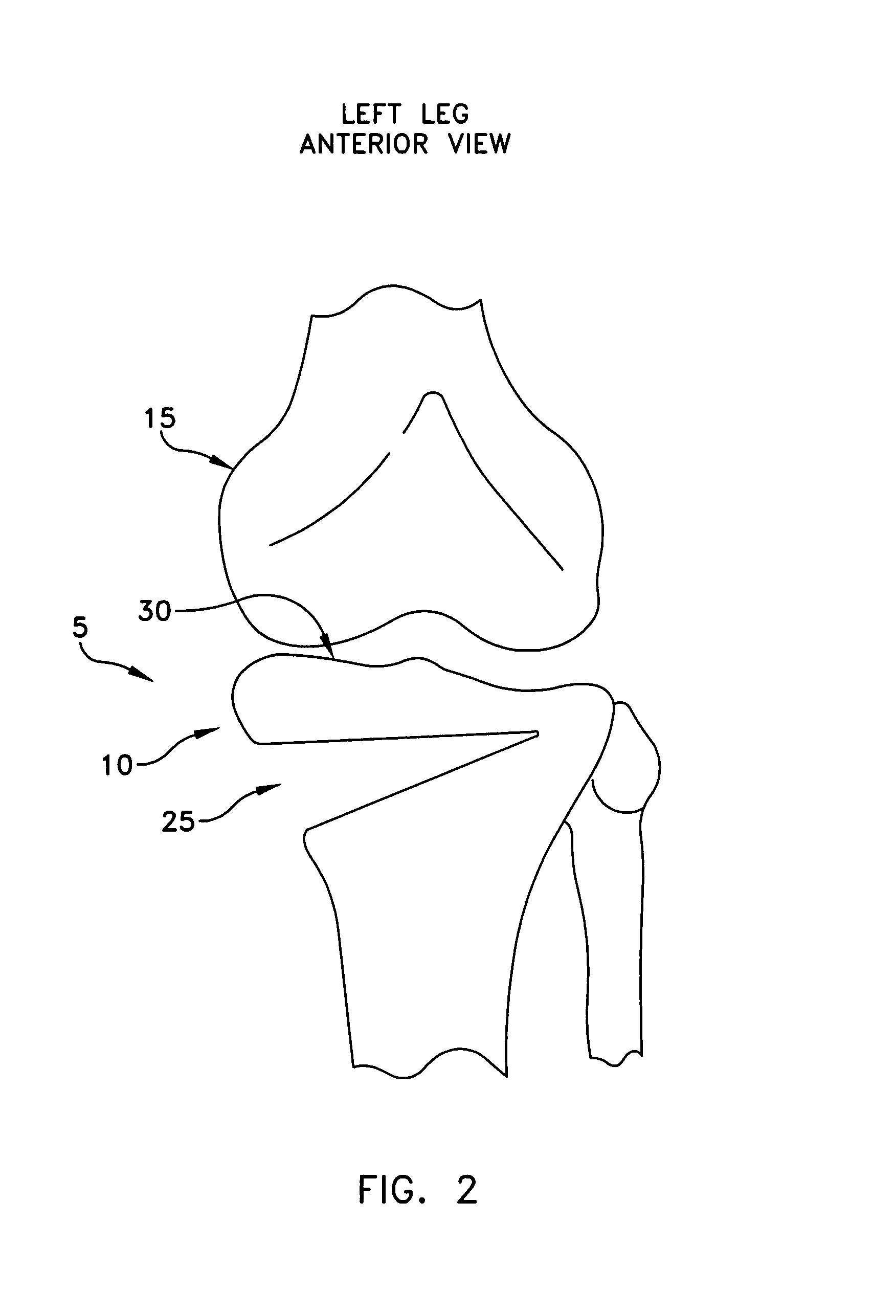 Method and apparatus for performing an open wedge, high tibial osteotomy