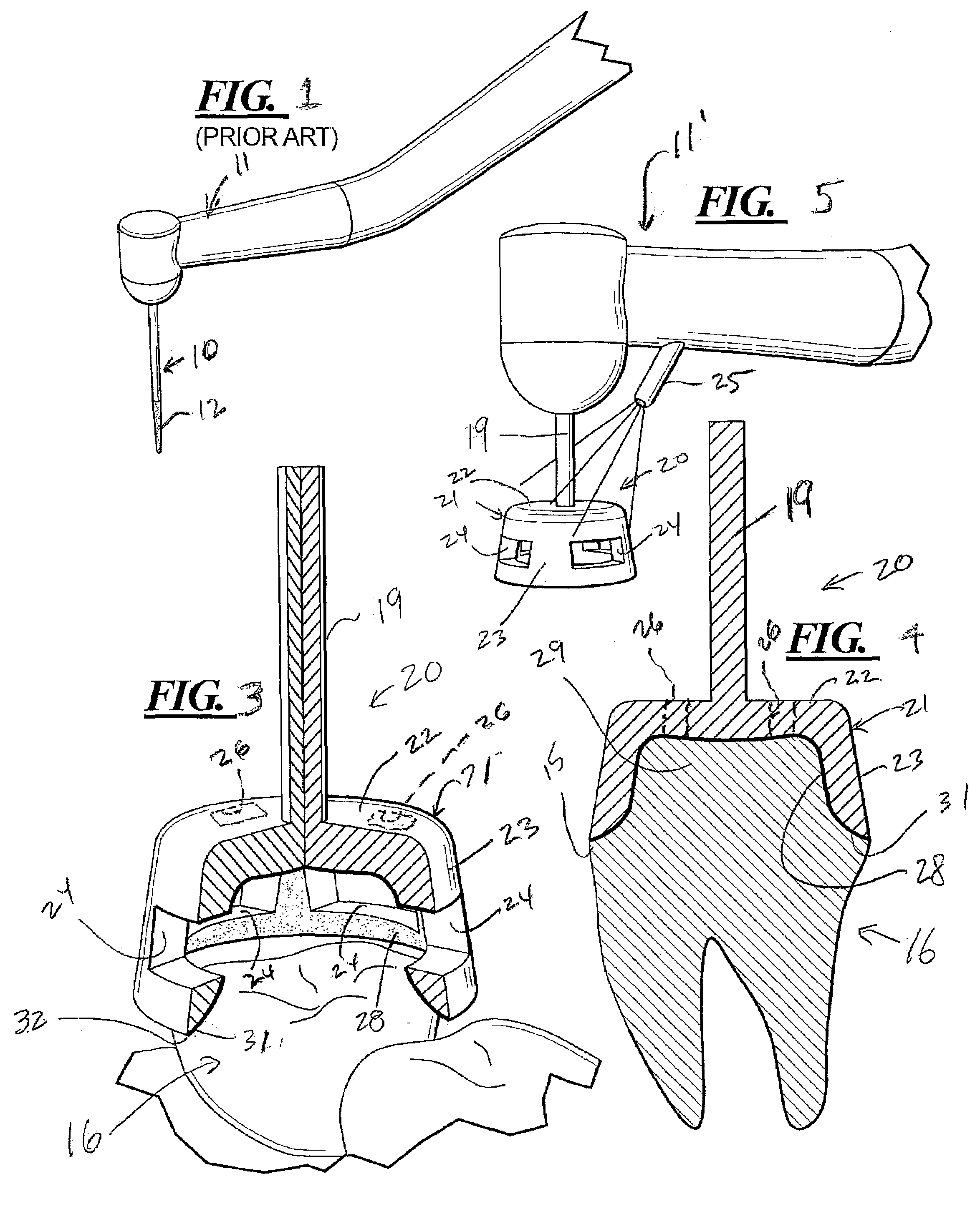 Truncated cone-shaped dental drill burr, measurement gauge and gingival cord applicator for dental crown preparation