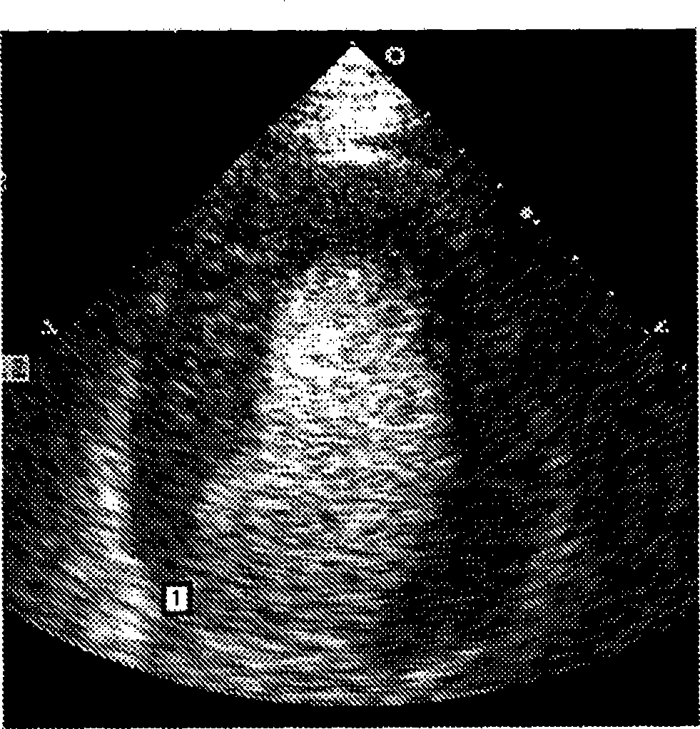 Quantification and display of cardiac chamber wall thickening