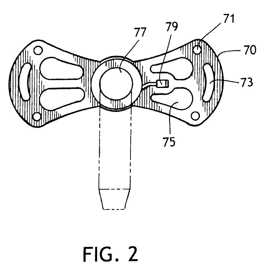 Tracheostomy Tube Butterfly Flange