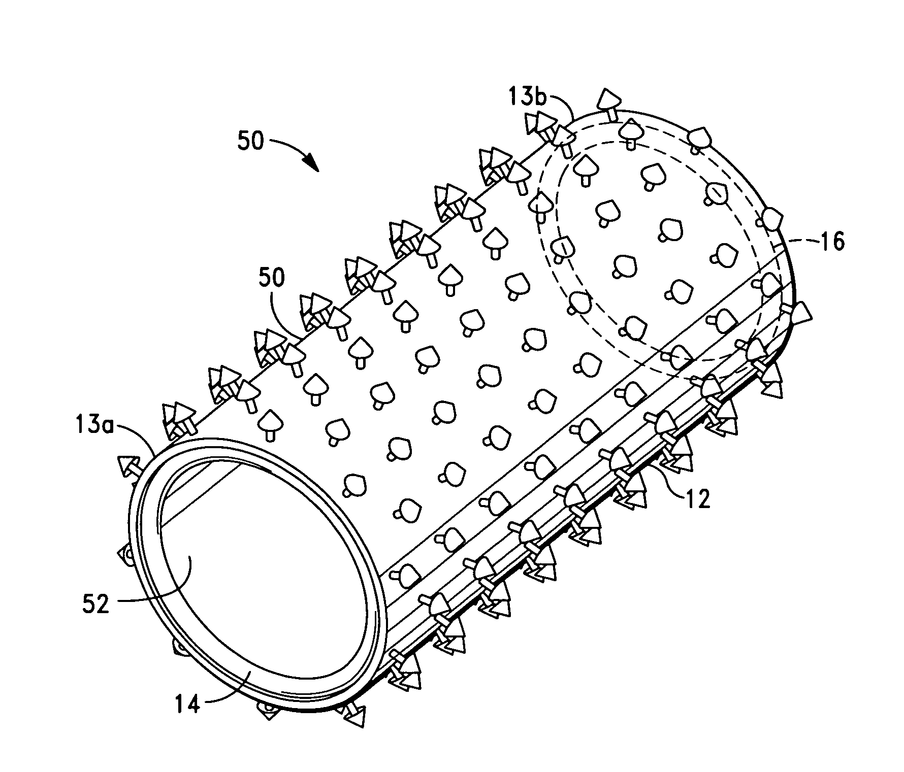 Vascular prosthesis