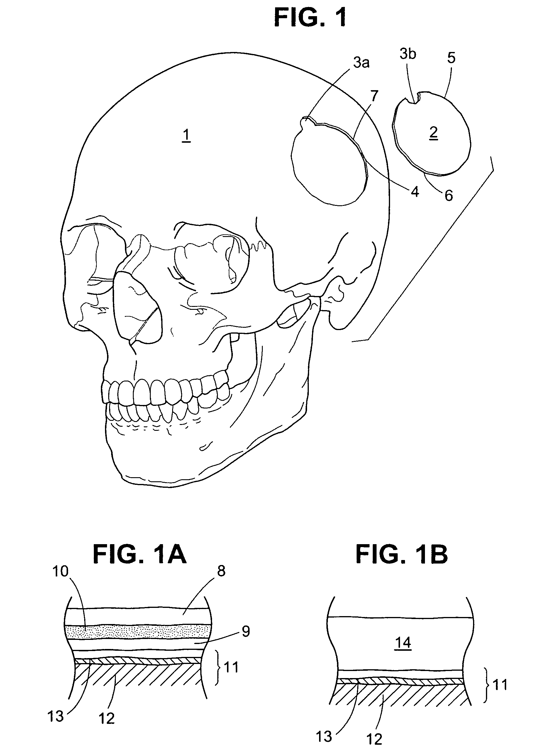 Craniotomy closures