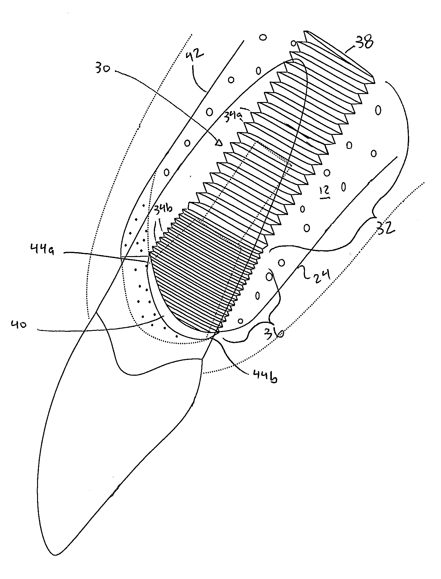 Modified asymmetrical dental implant