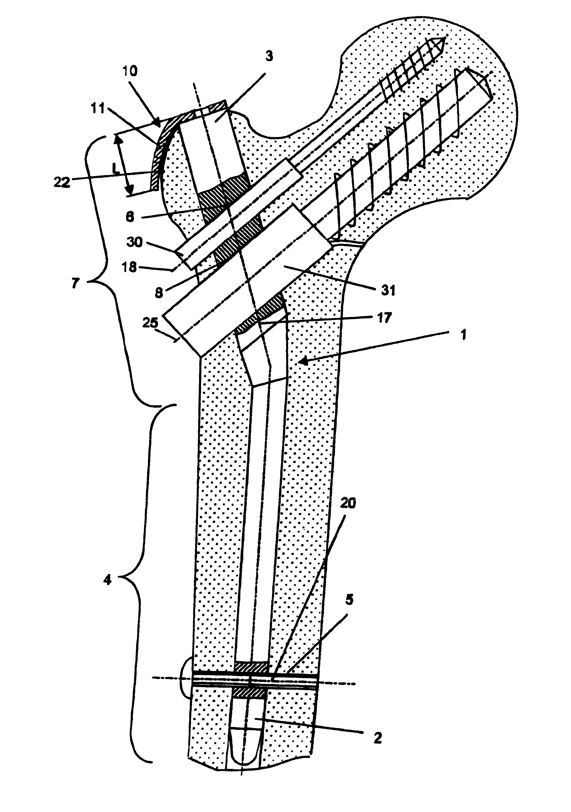 Device for bone fixation