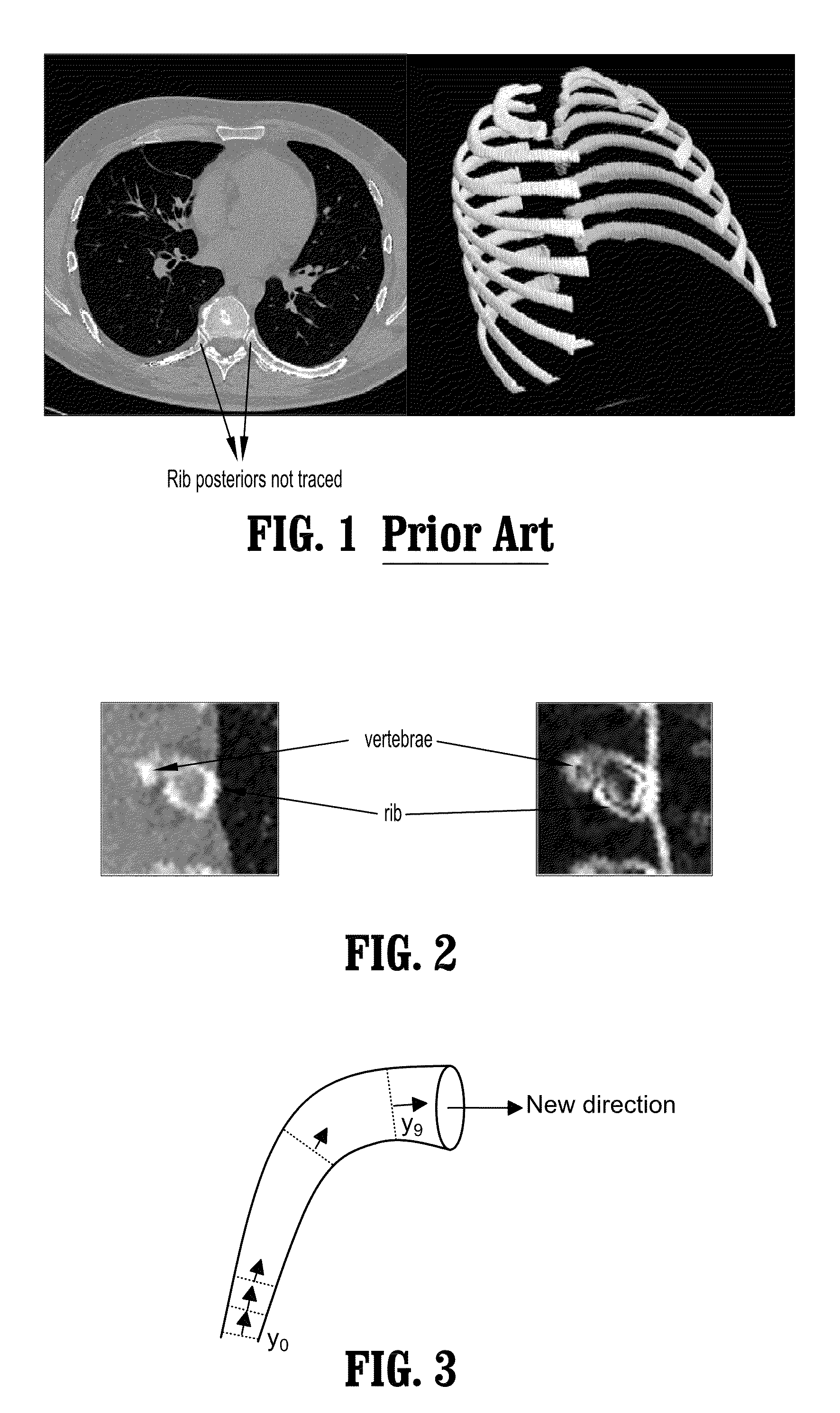 System and method for tracing rib posterior in chest CT volumes