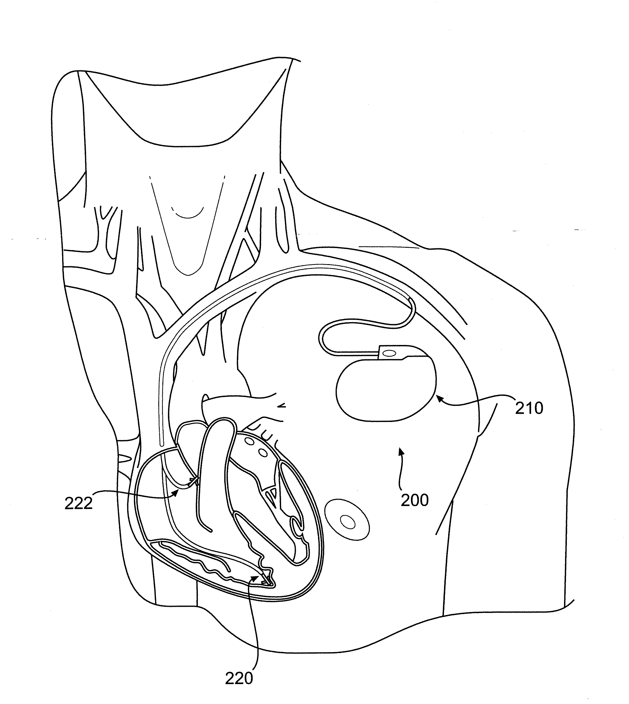 System and method for determining the origin of a sensed beat