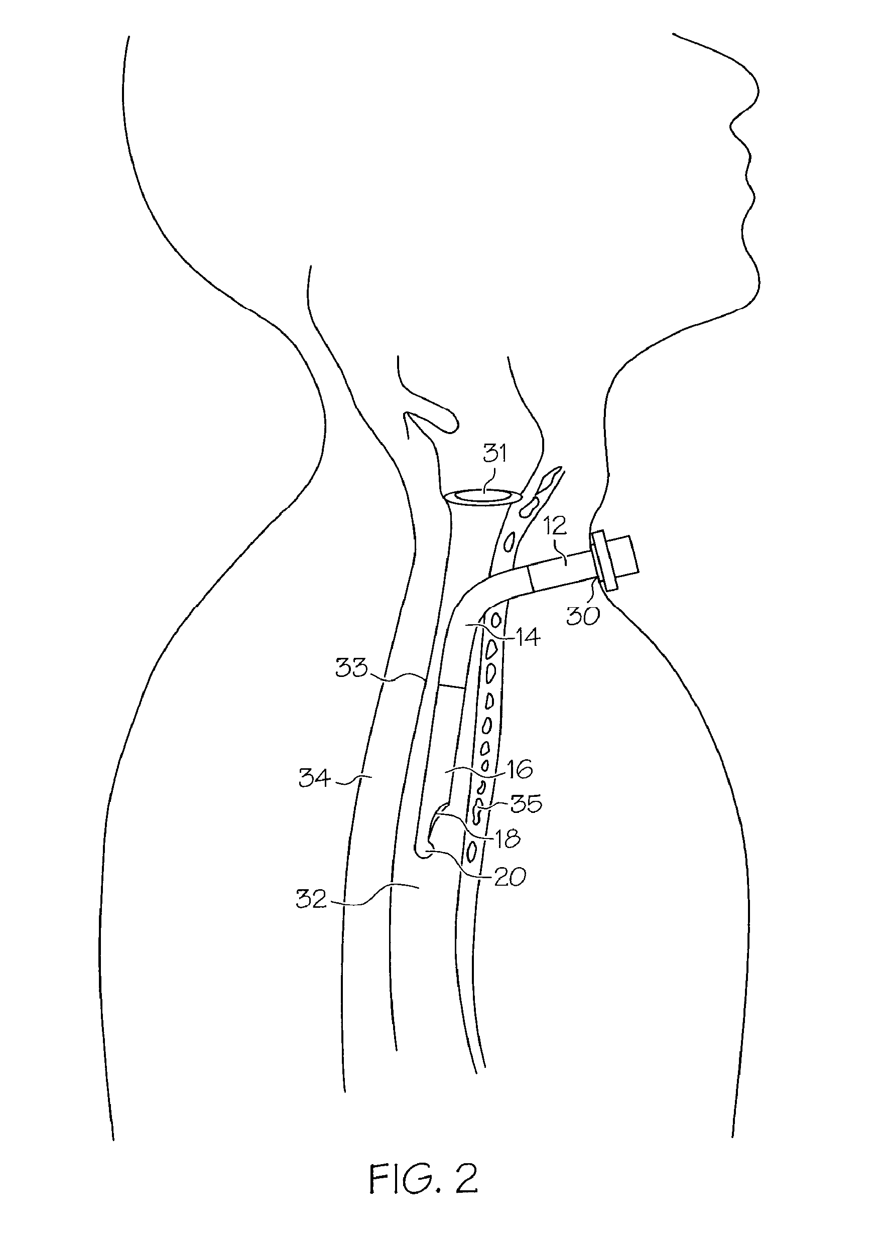 Tracheostomy tube