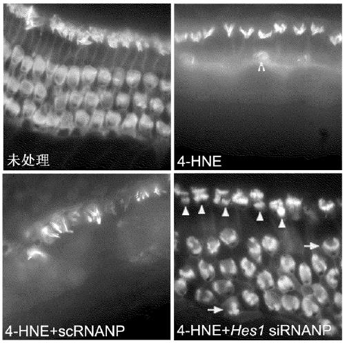 Combination therapies for inner ear sensory hair cell regeneration/replacement