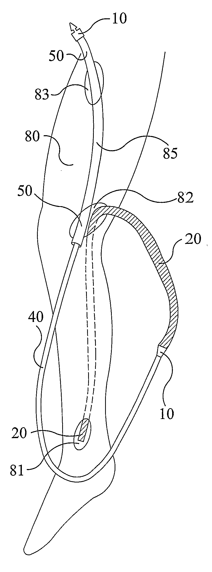 Tunnelling Instrument for Subcutaneously Placing an Article, and Method of Use of Said Instrument