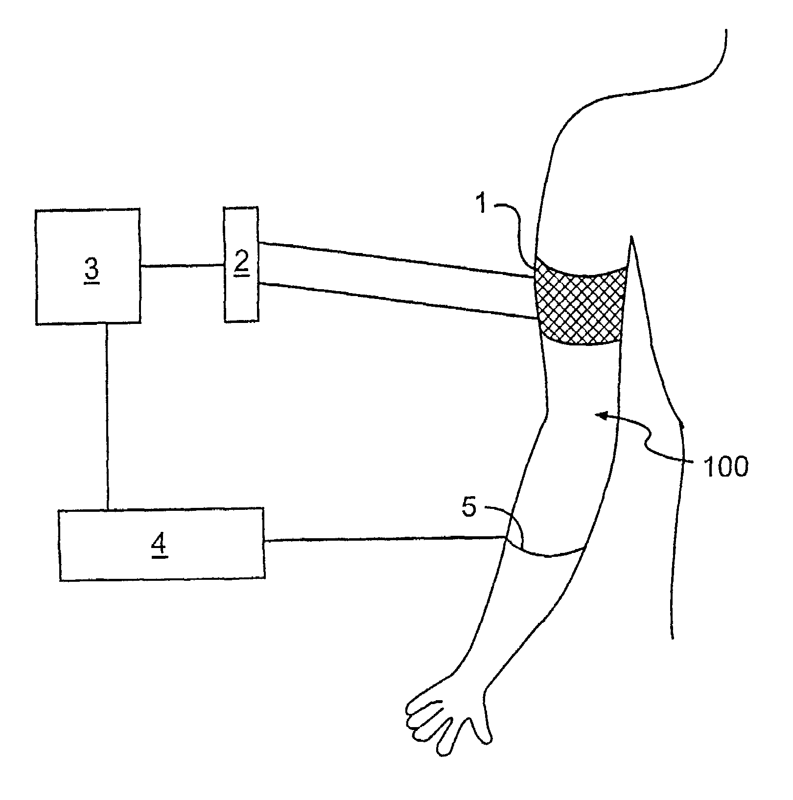 Methods for monitoring and optimizing central venous pressure and intravascular volume