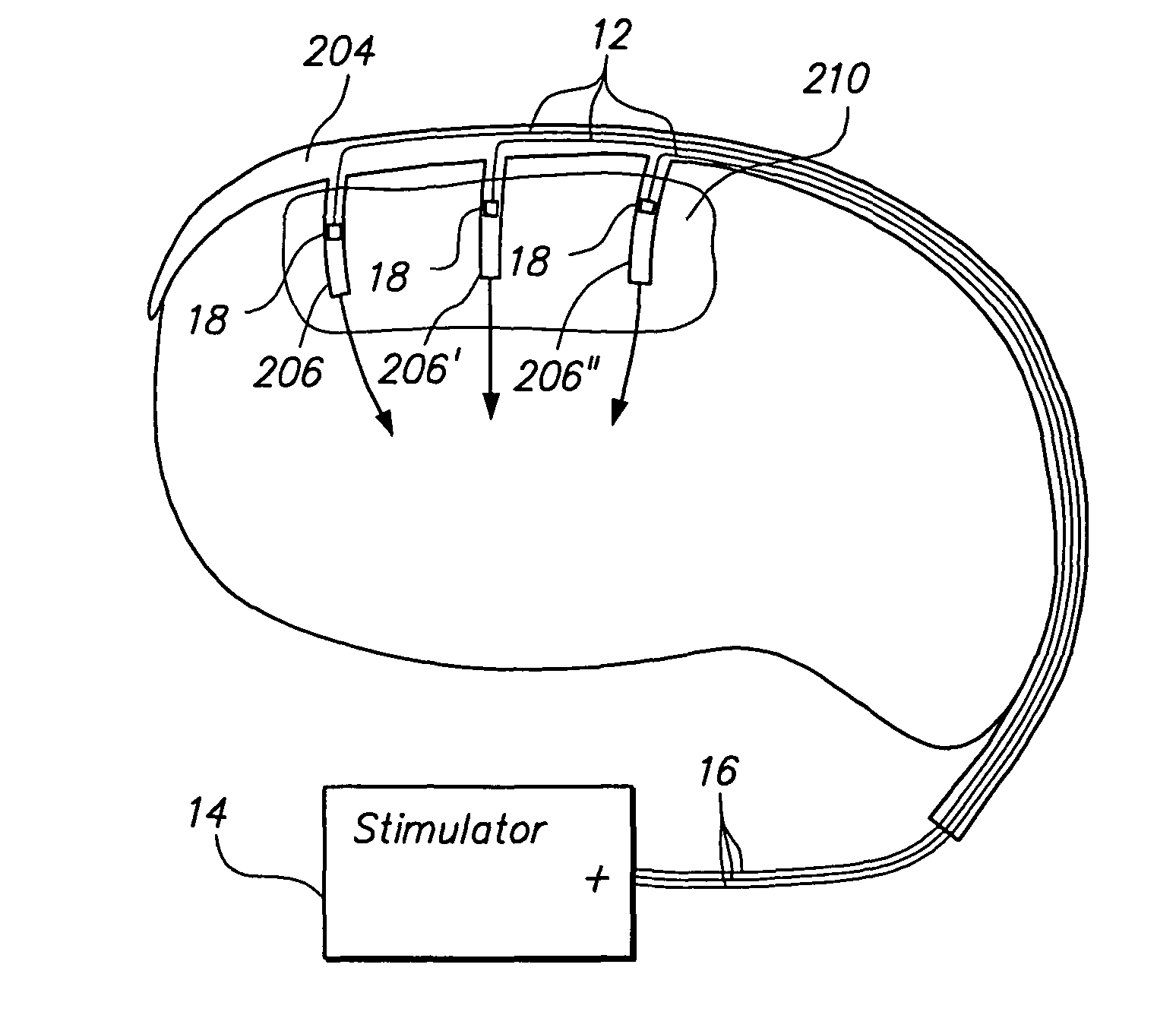 Method of intravascularly delivering stimulation leads into direct contact with tissue