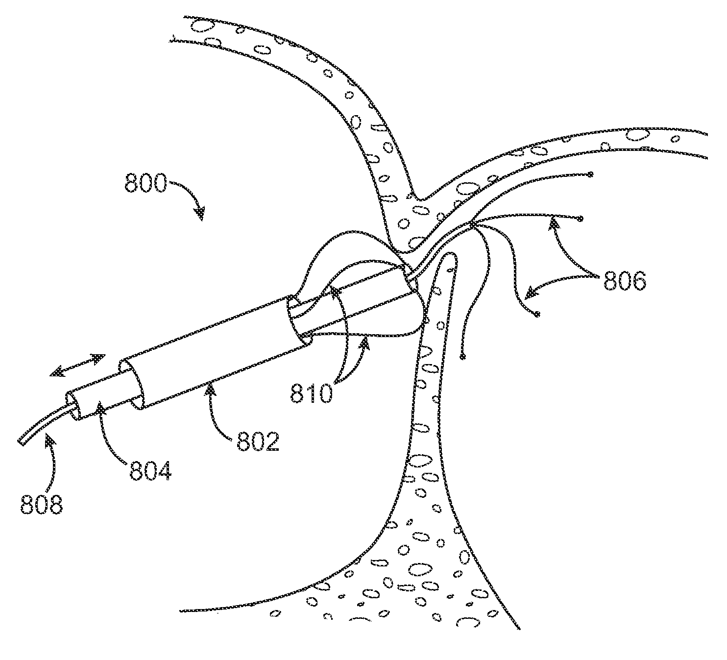 Energy based devices and methods for treatment of patent foramen ovale