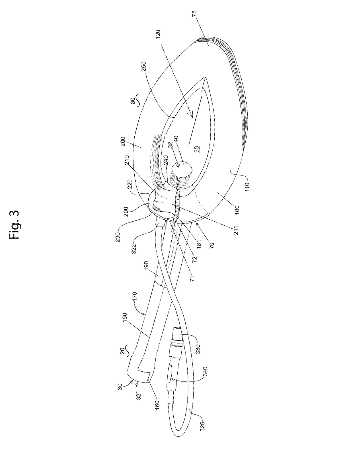 Easily removable intubating LMA