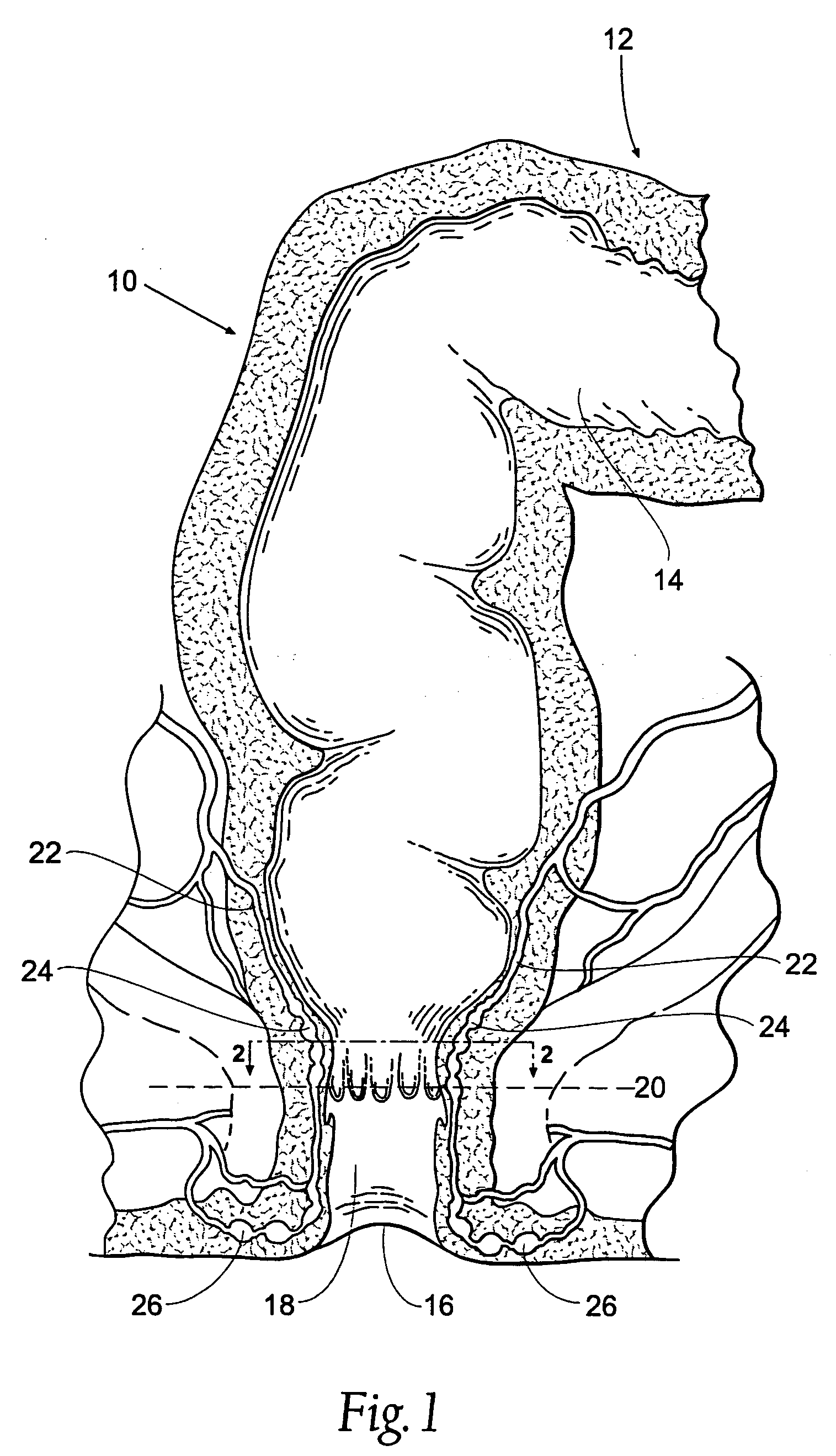 Systems and methods for treating hemorrhoids