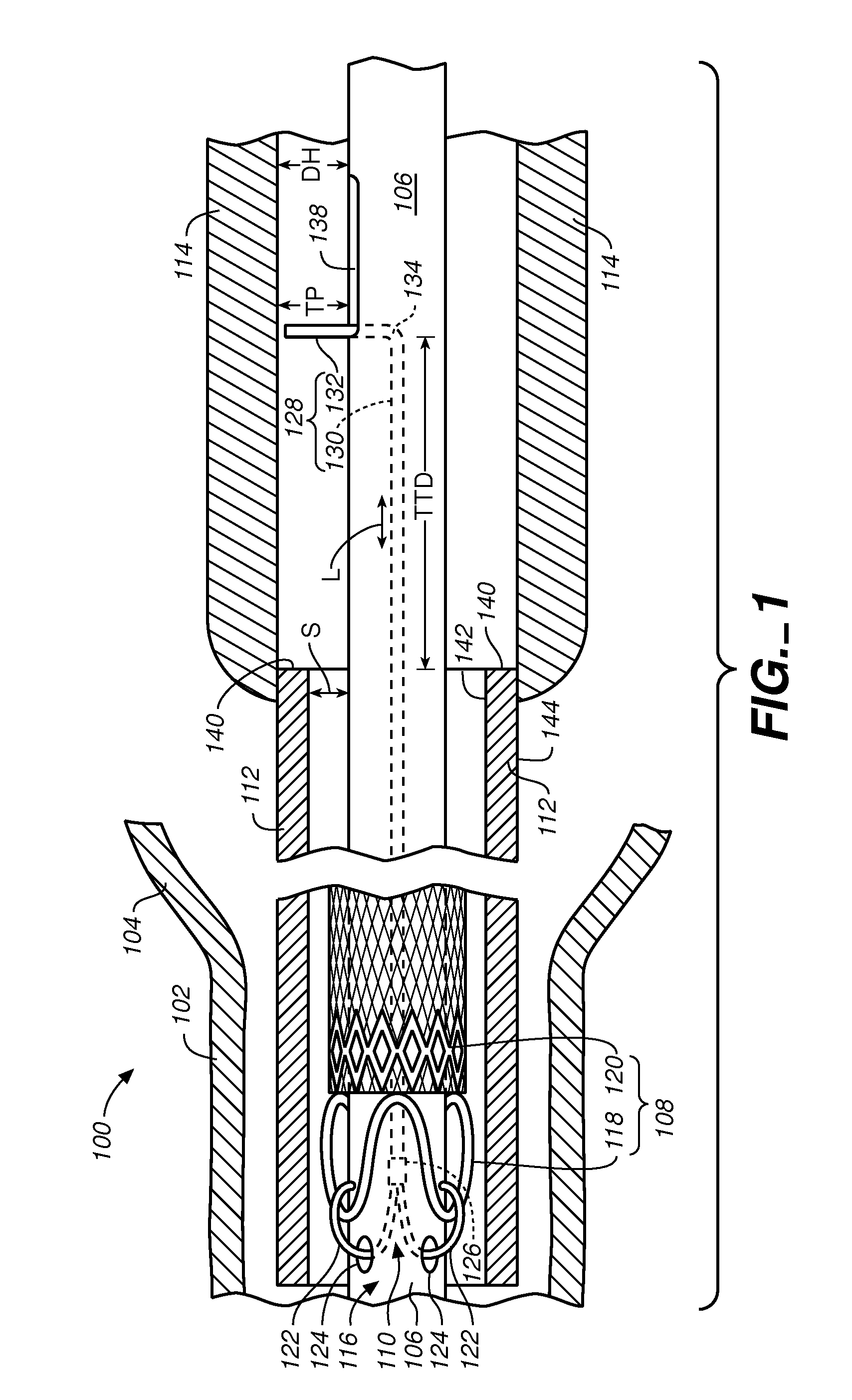 Stent-Graft Delivery System