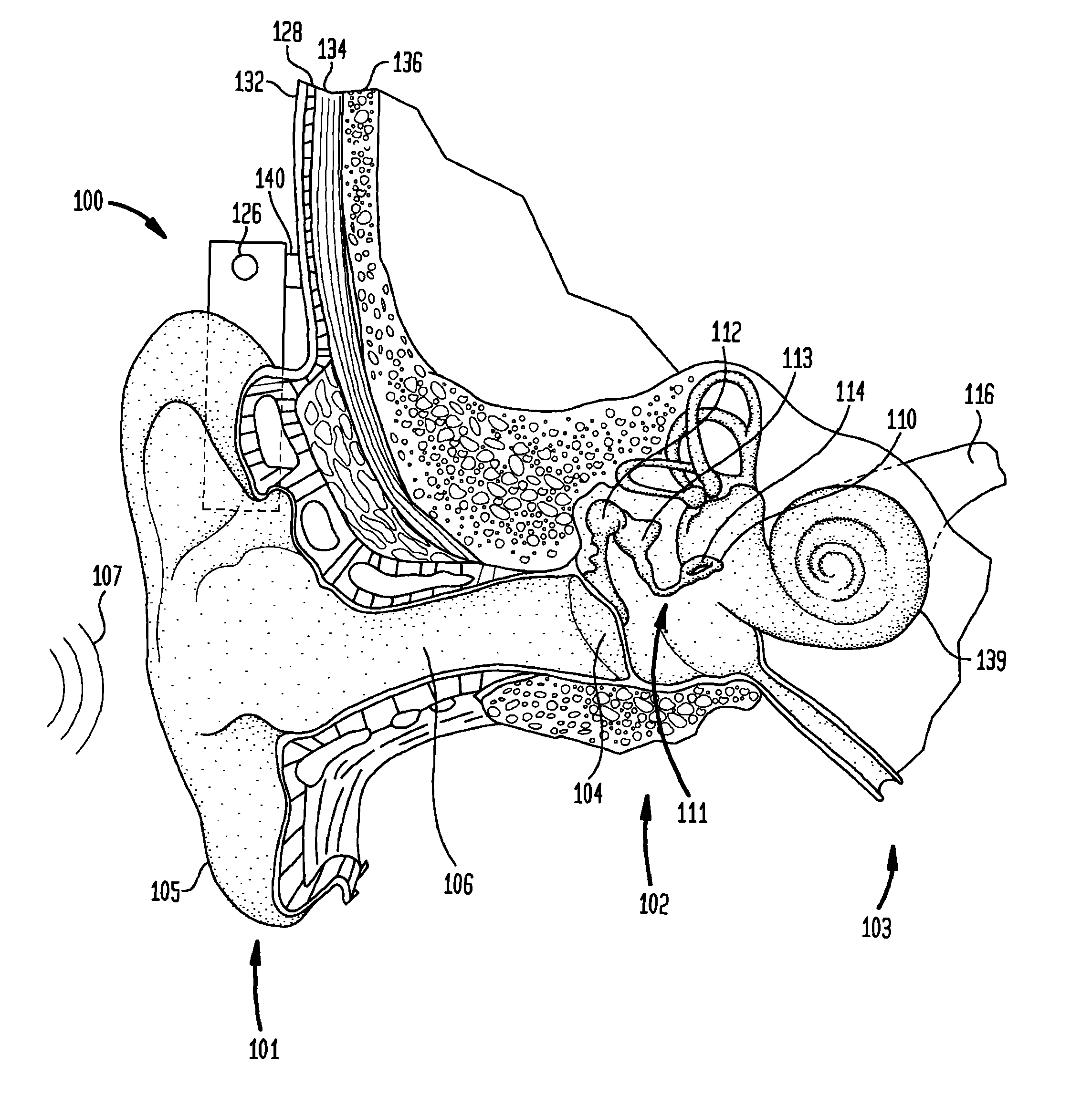 Bone conduction device having limited range of travel