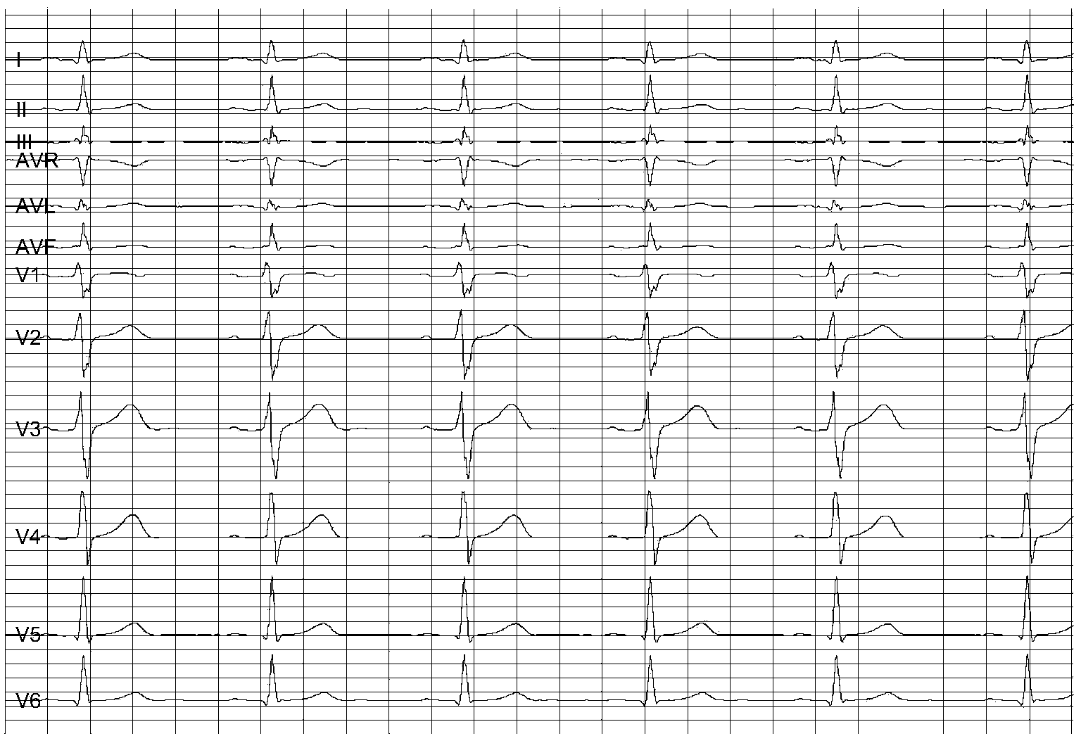 Myocardial ischemia auxiliary detecting method based on deterministic learning theory