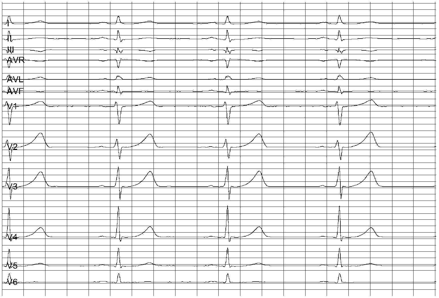 Myocardial ischemia auxiliary detecting method based on deterministic learning theory