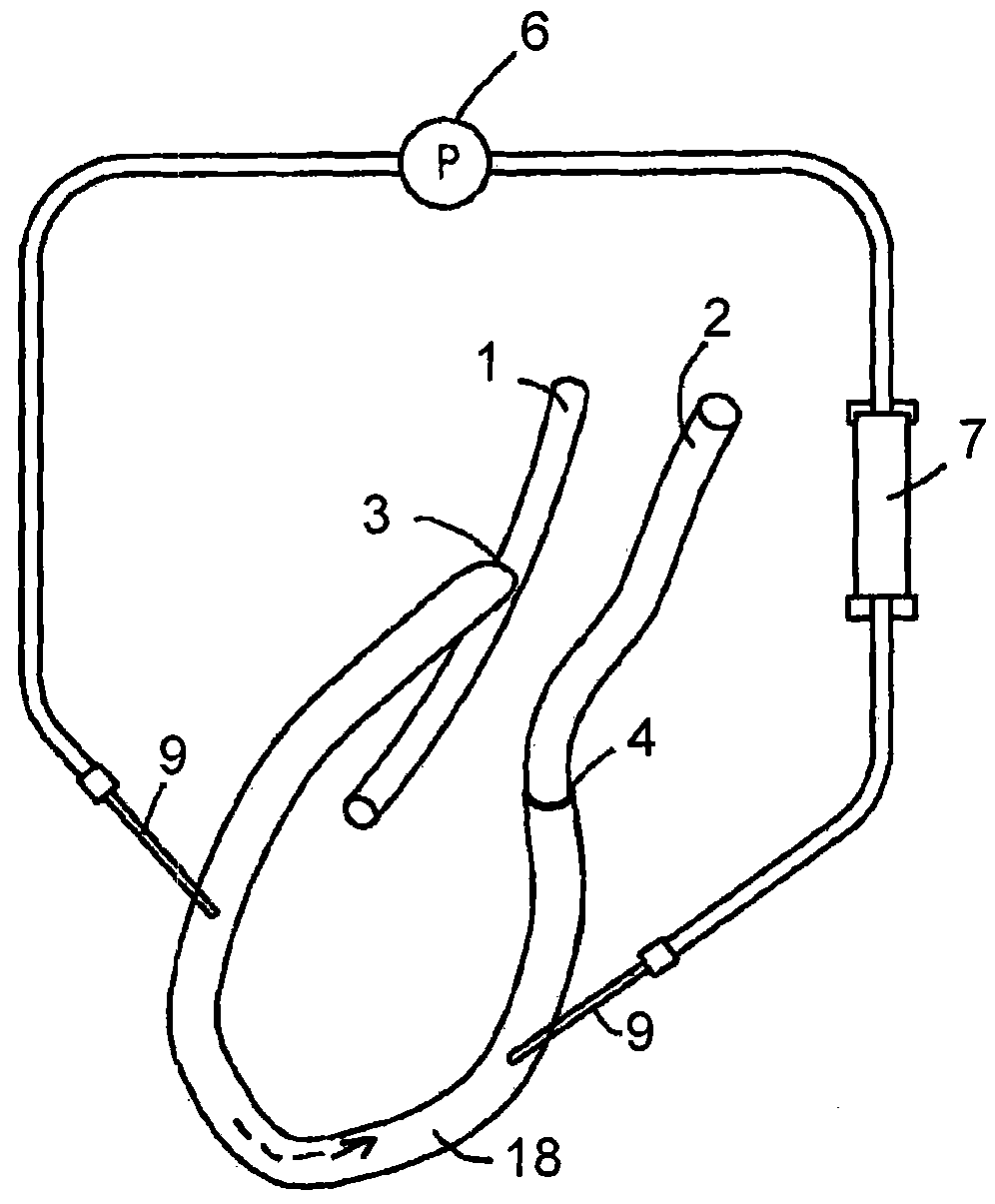 Hemodialysis arterio-venous graft with a ring-like diameter-adjustable device