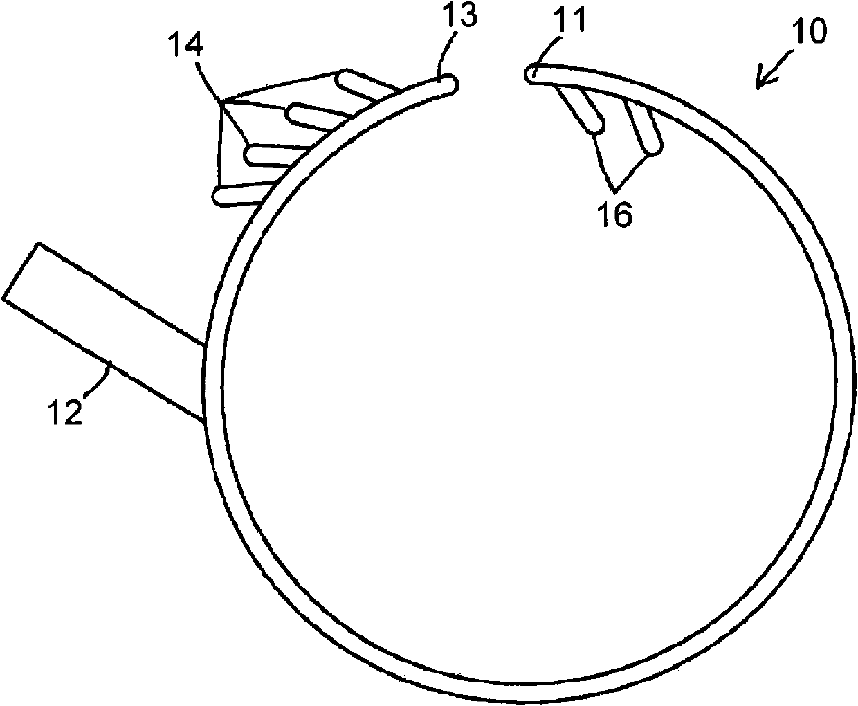 Hemodialysis arterio-venous graft with a ring-like diameter-adjustable device