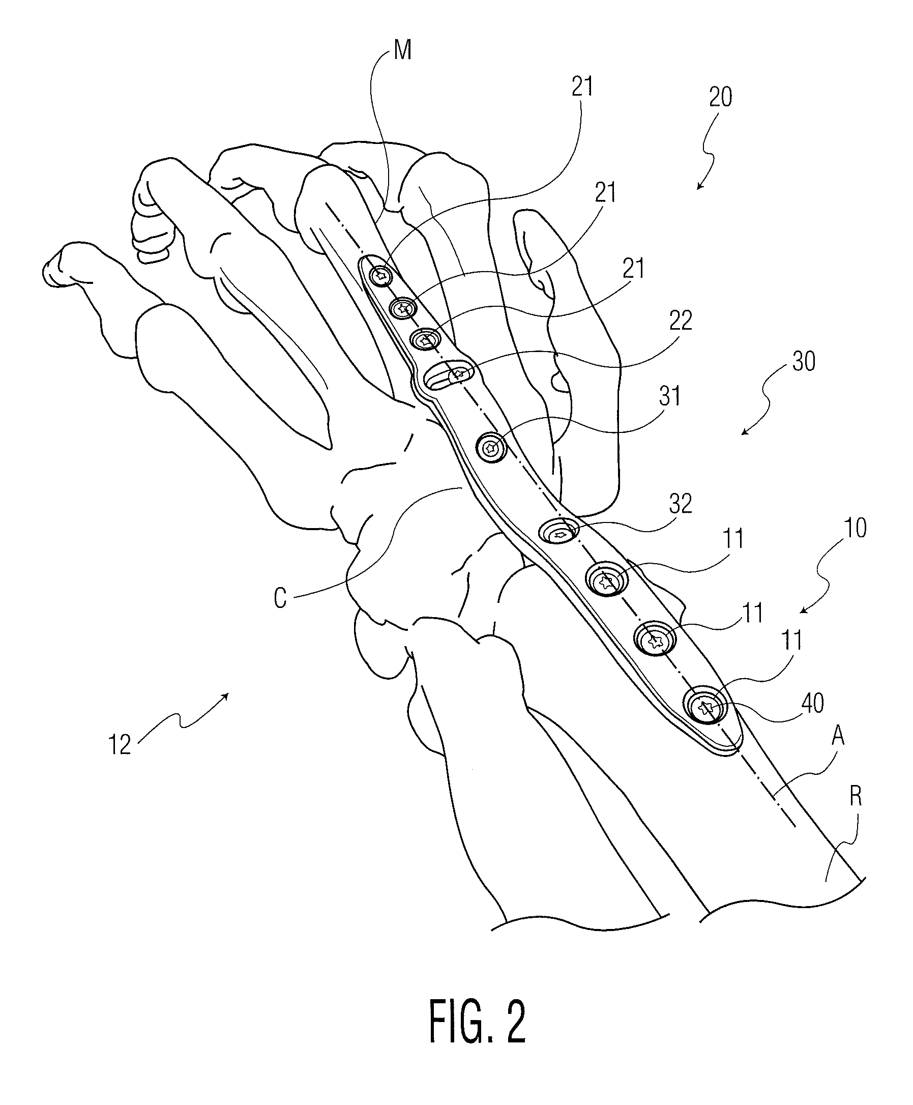 Wrist fusion plate