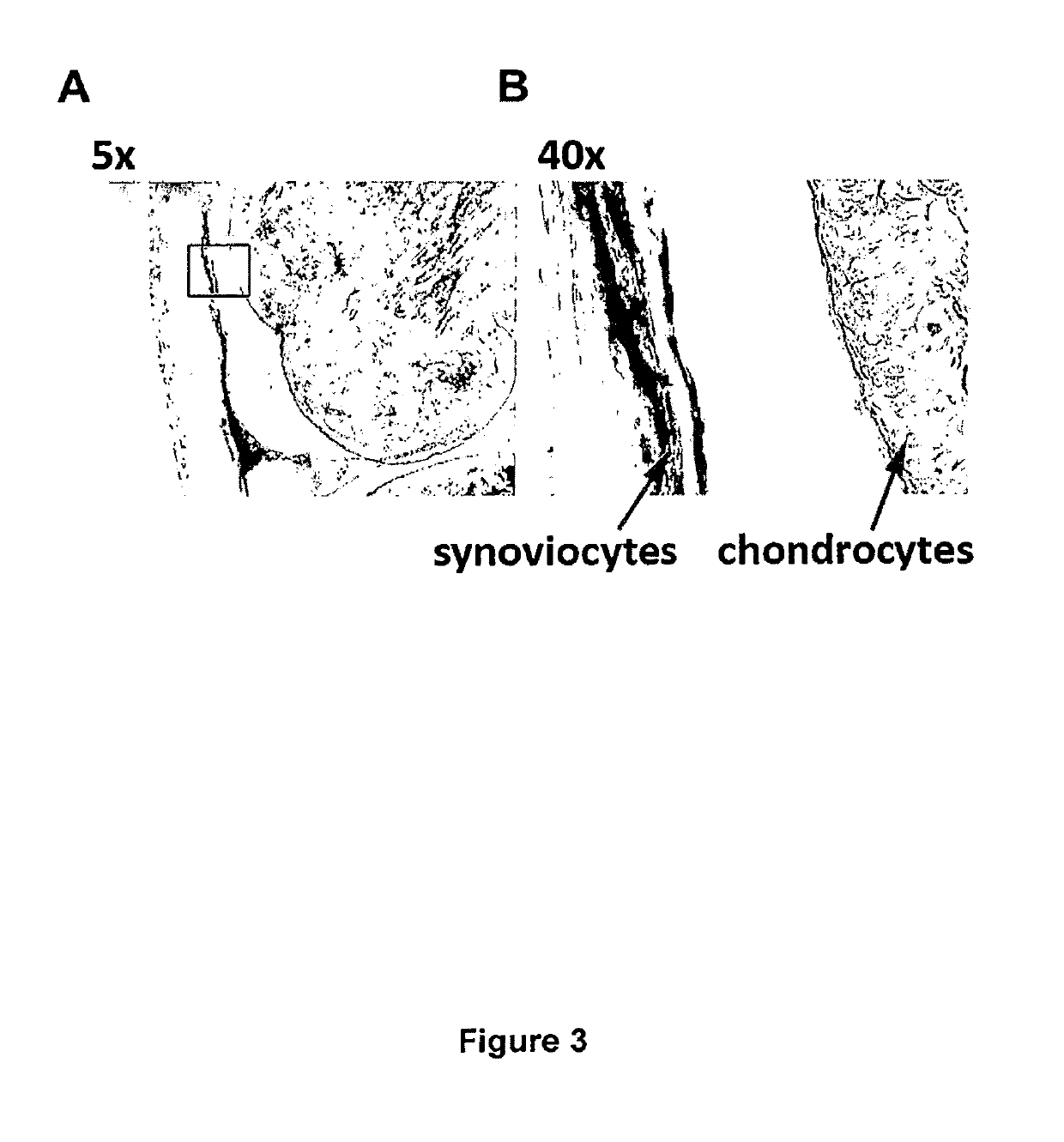 Adenoviral-based biological delivery and expression system for use in the treatment of osteoarthritis