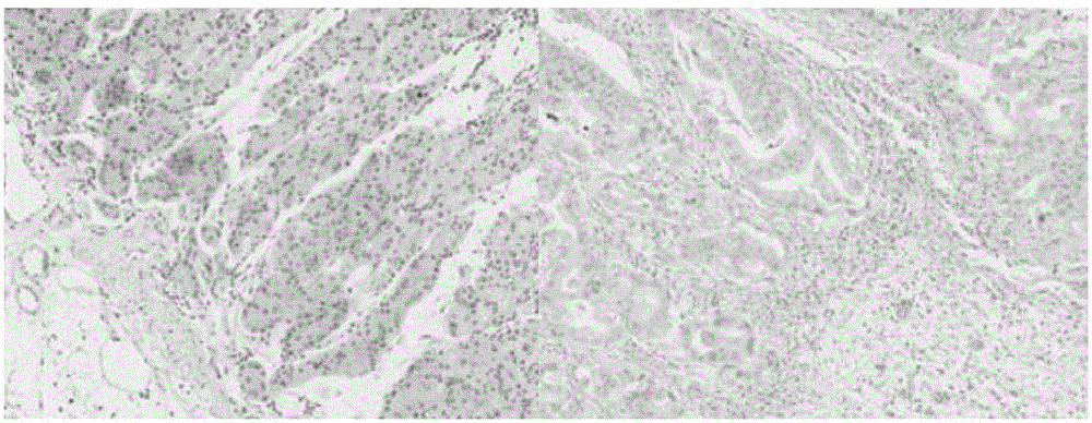 Gastric cancer detection kit adopting HOXB9 and PBX1 as biomarkers and application