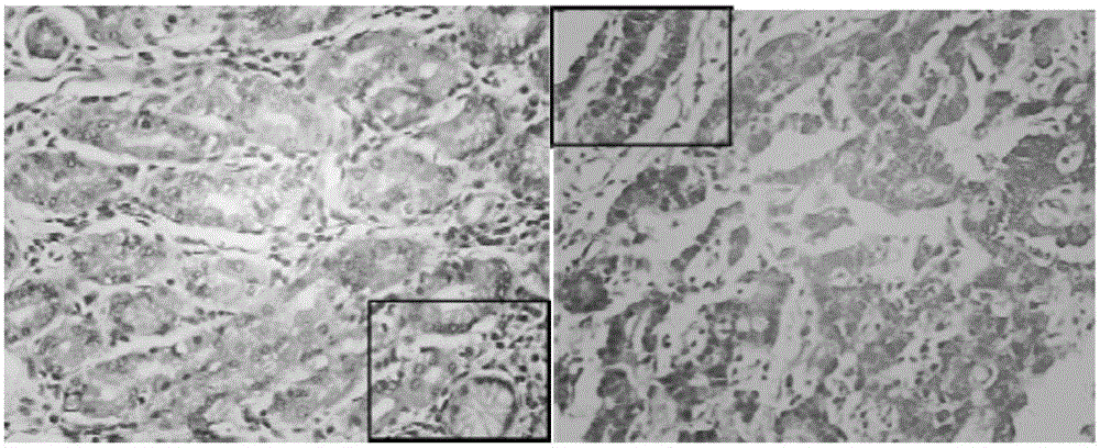 Gastric cancer detection kit adopting HOXB9 and PBX1 as biomarkers and application