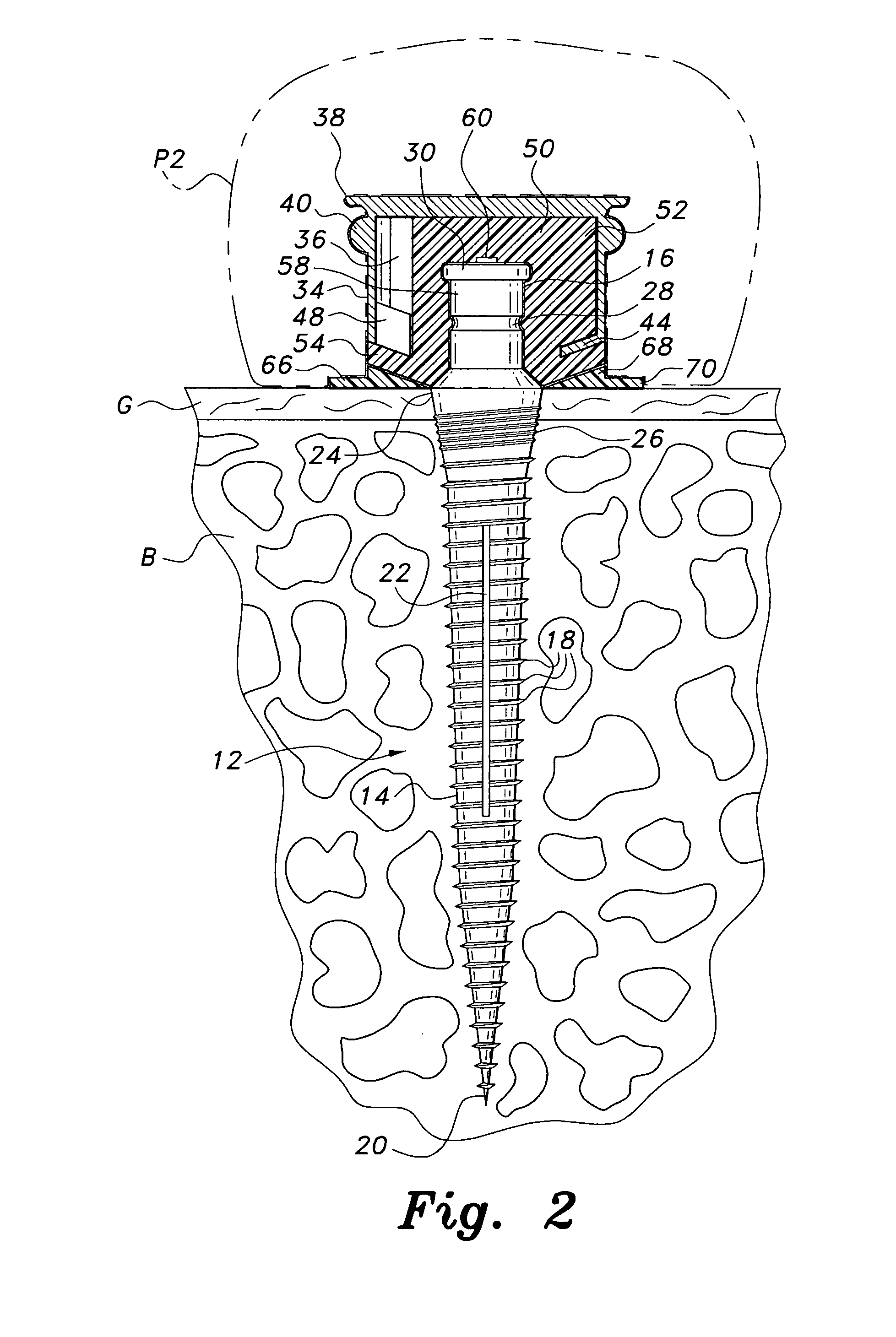 Dental implant system