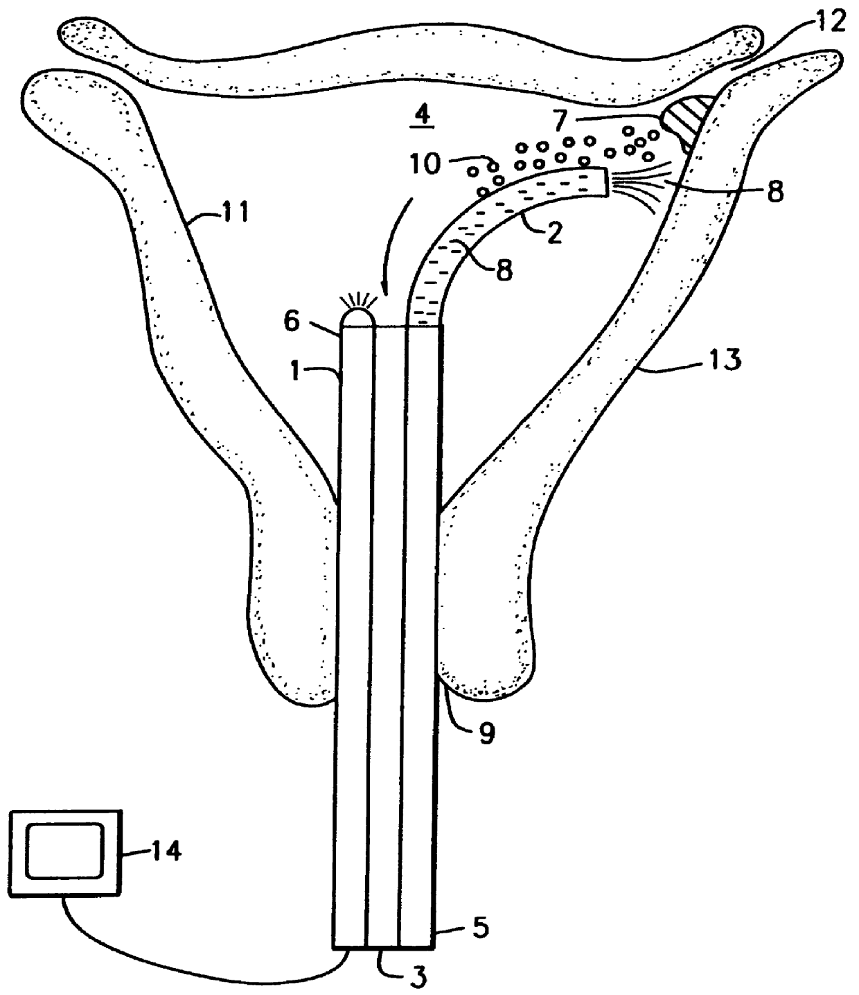 Intrauterine chemical necrosing method, composition, and apparatus