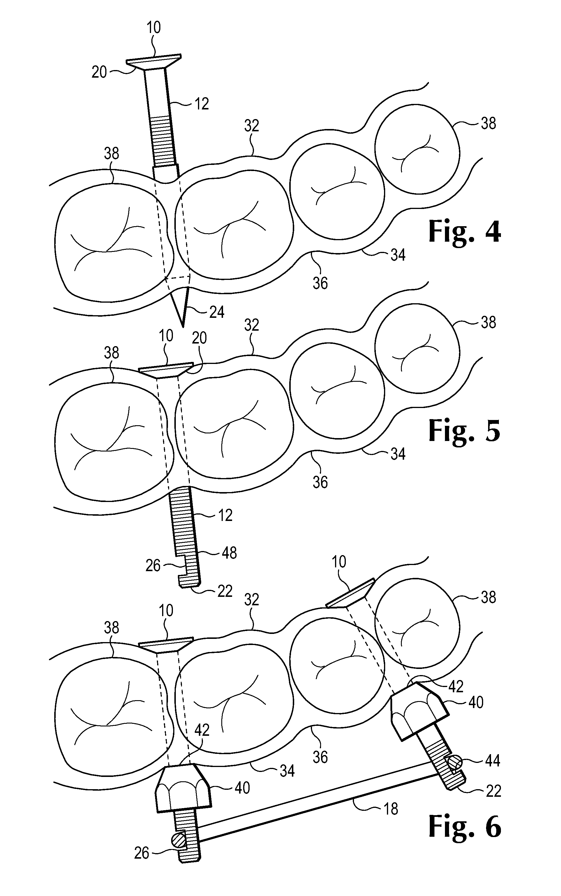 Method and apparatus for maxillo-mandibular fixation