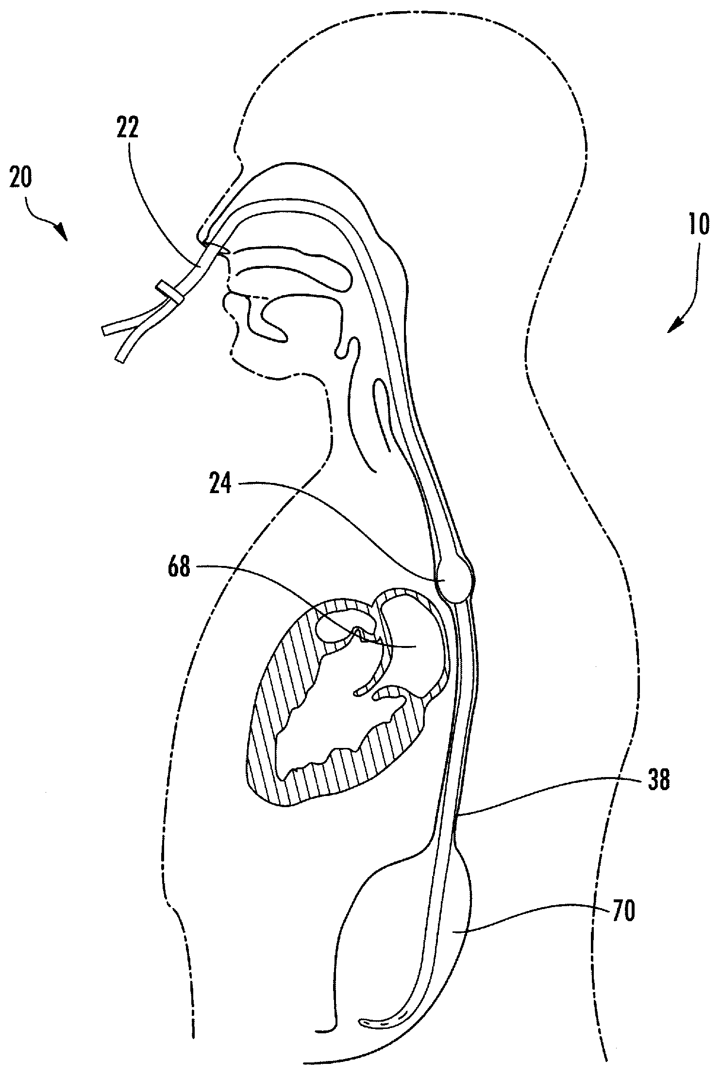 Esophageal cooling system for ablation procedures associated with cardiac arrhythmias