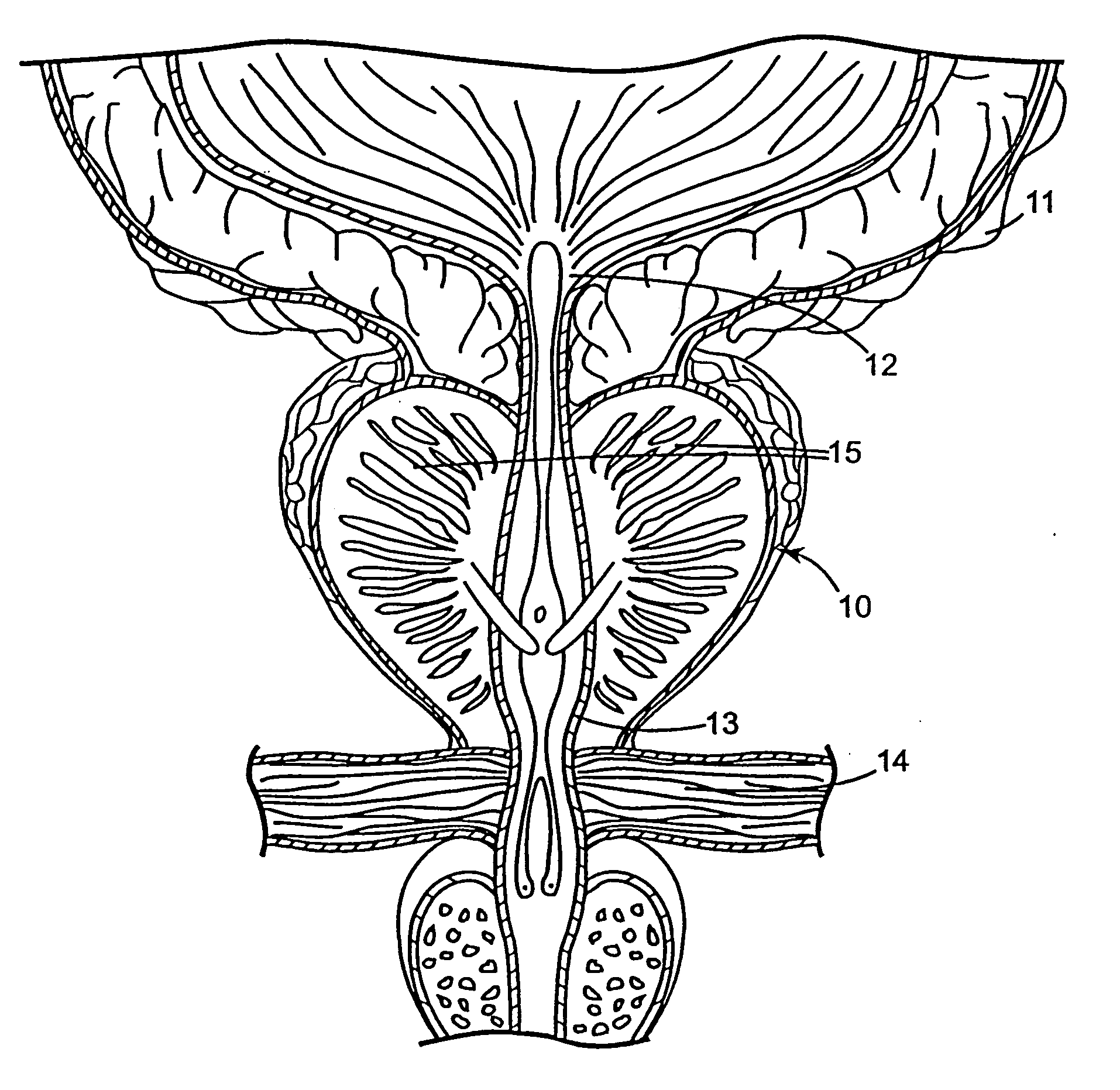 Regimen for treating prostate tissue and surgical kit for use in the regimen